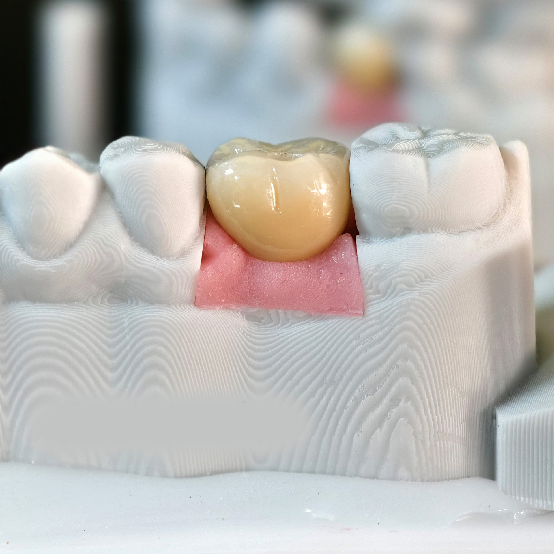 Zirconia Crowns With Screw Retained