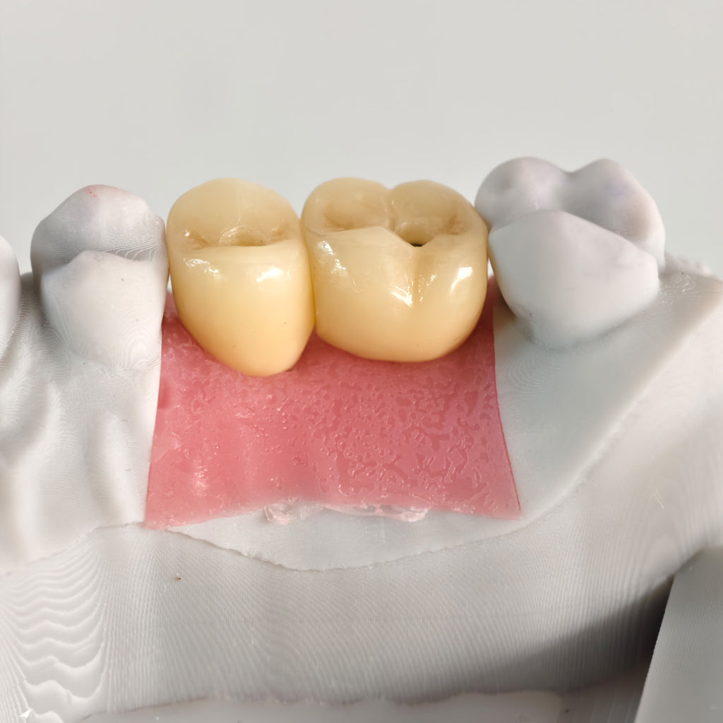 Zirconia Crowns With Screw Retained And Gold-Plated Custom Abutment