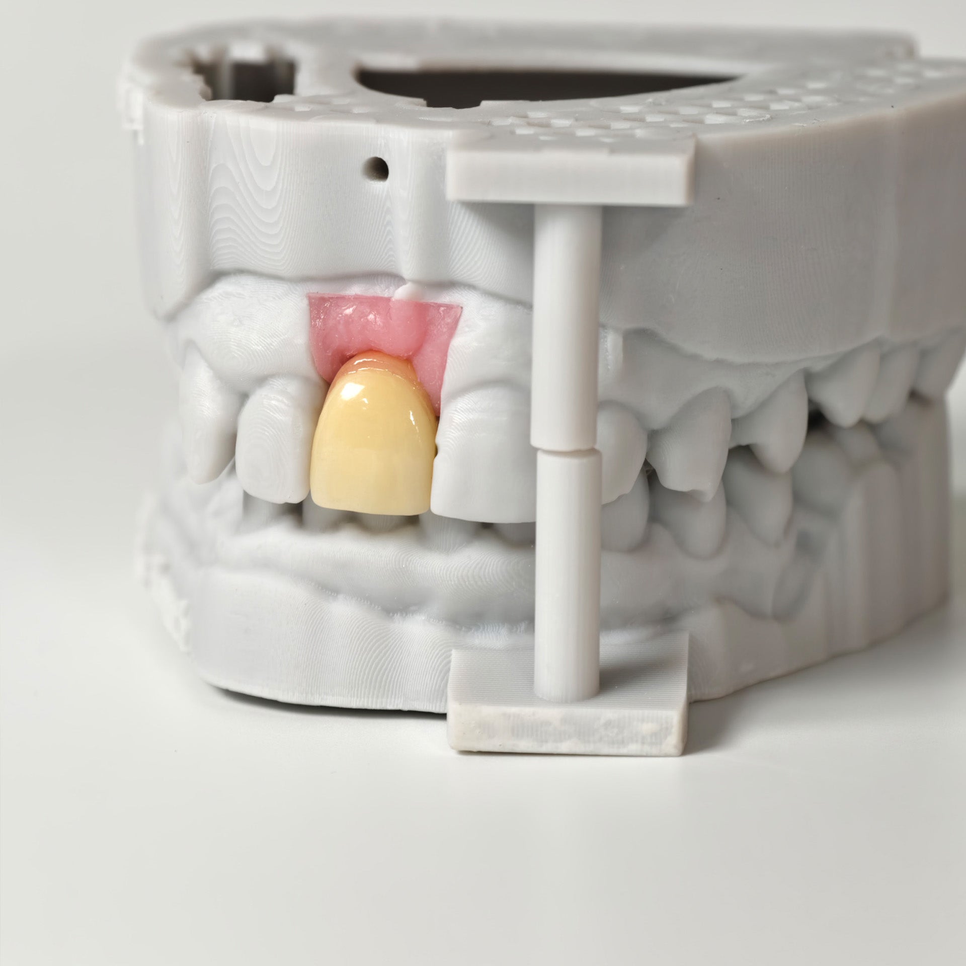 Zirconia Crown With Gold-Plated Abutment
