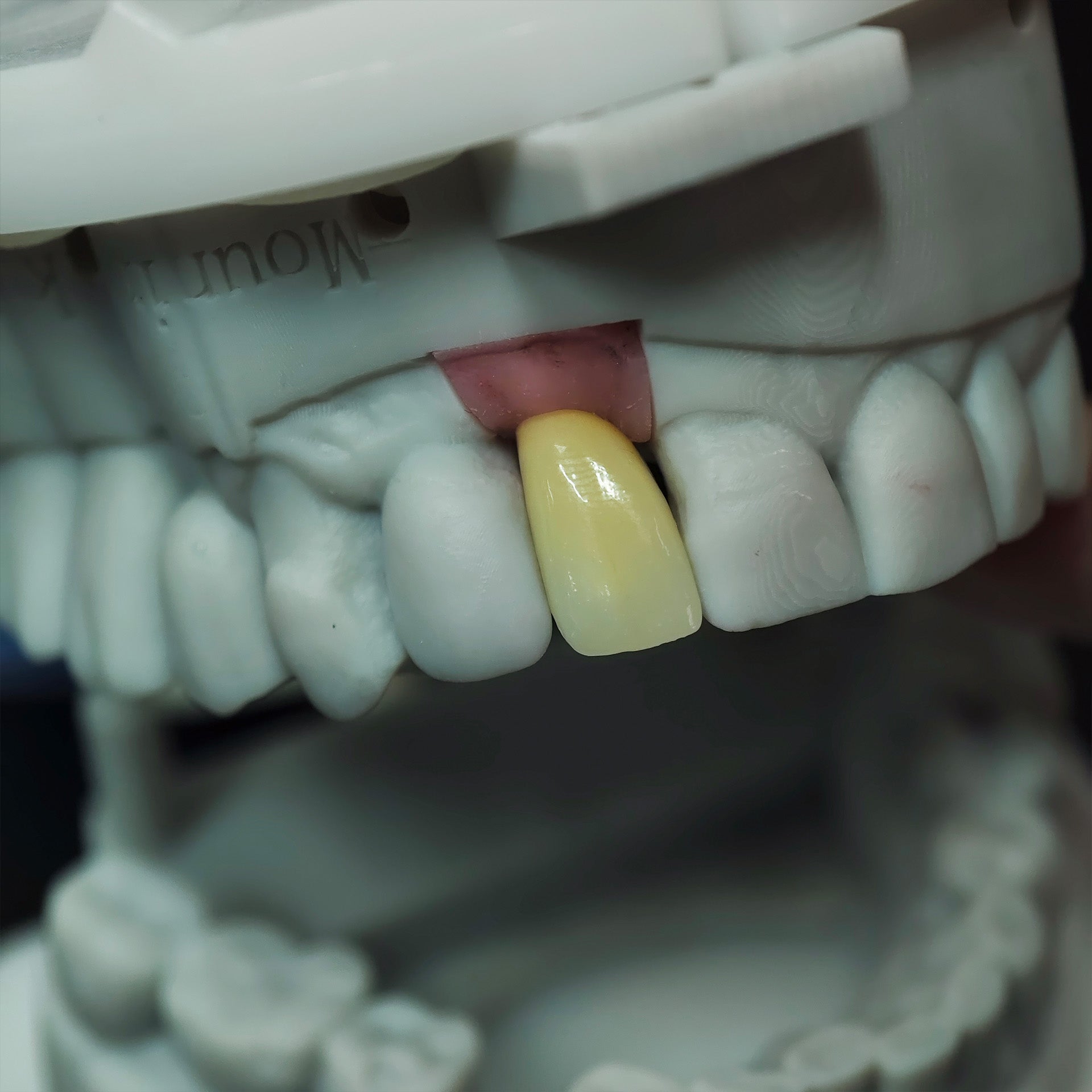 Zirconia Crown With Screw Retained