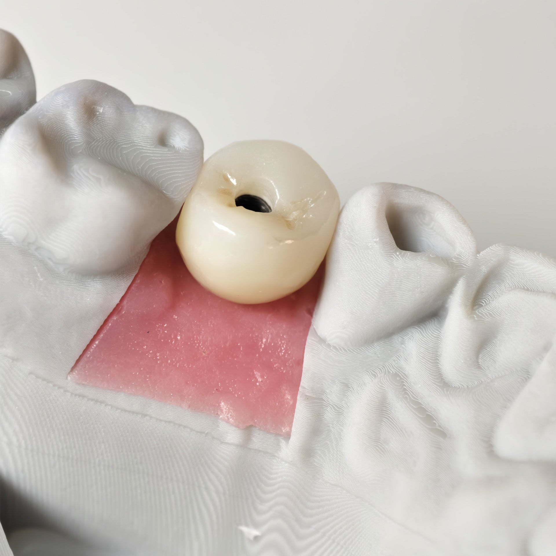 Zirconia Crown With Screw Retained