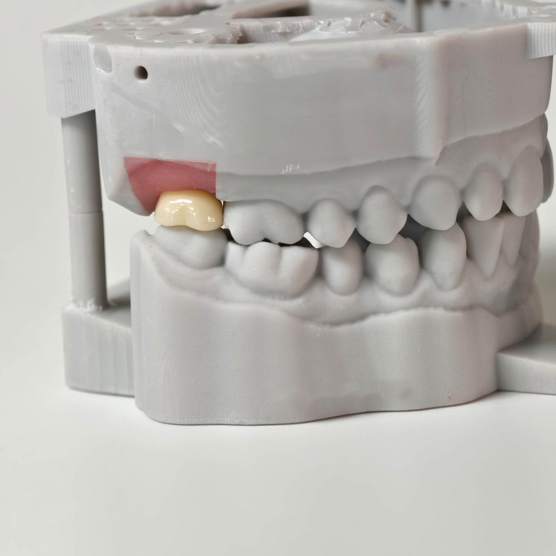 Zirconia Crown With Screw Retained