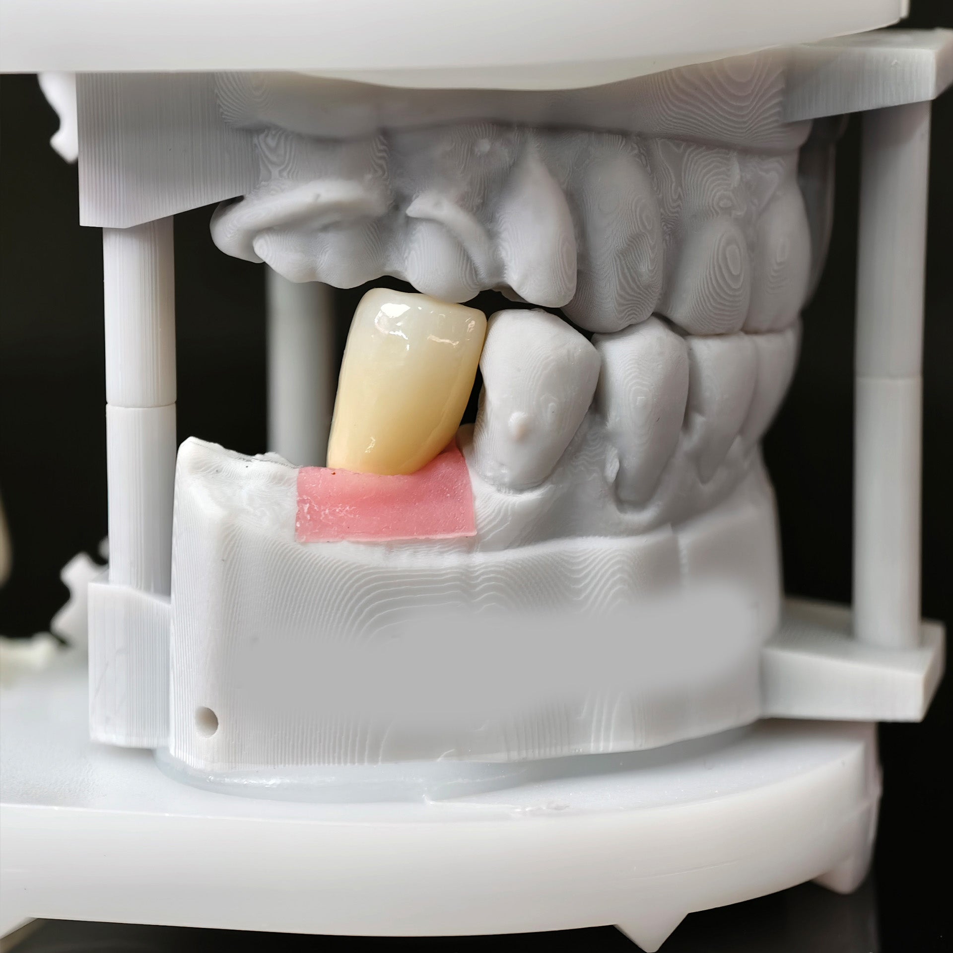 Zirconia Crown With Screw Retained