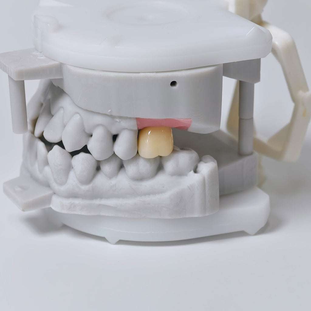 Zirconia Crown With Screw Retained