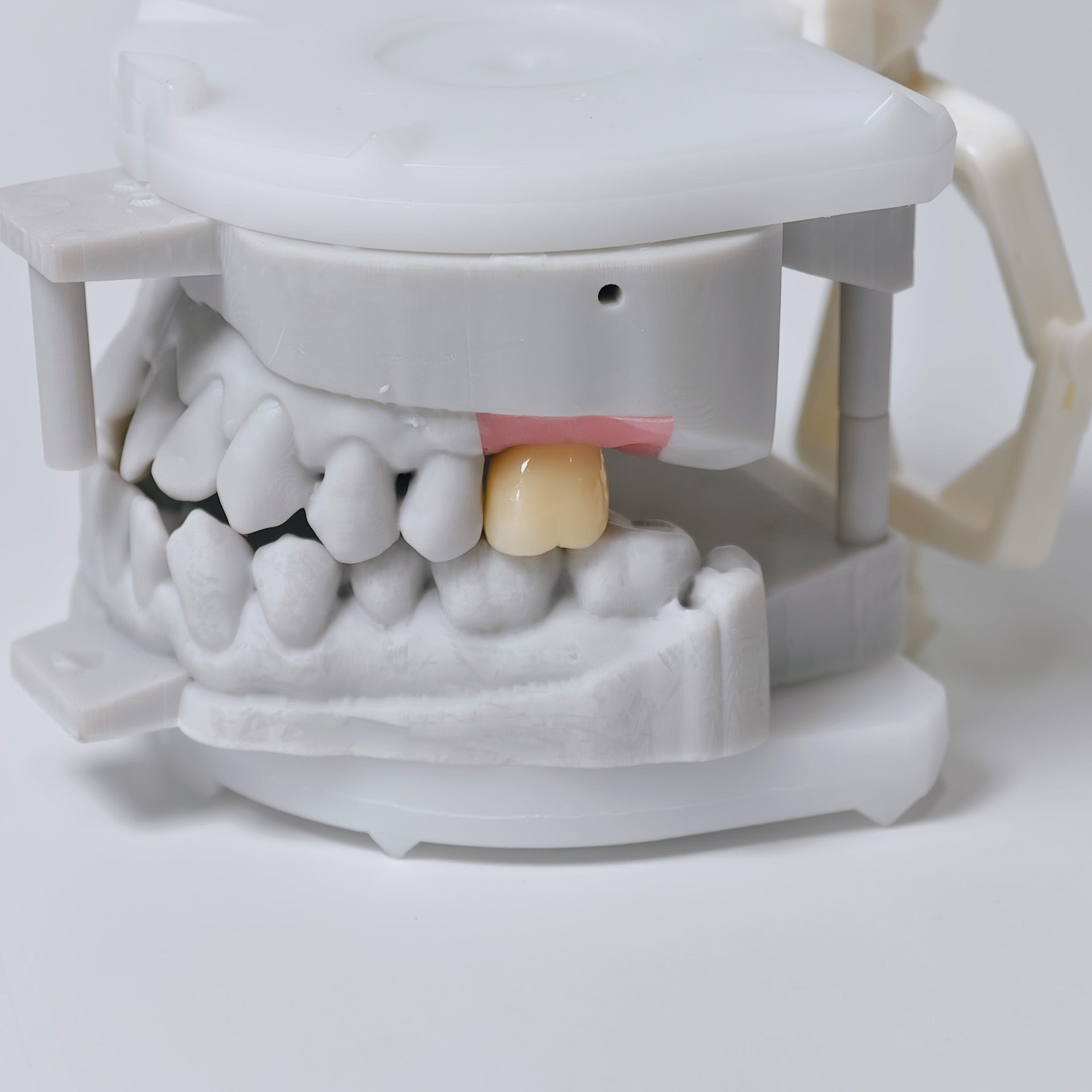 Zirconia Crown With Screw Retained
