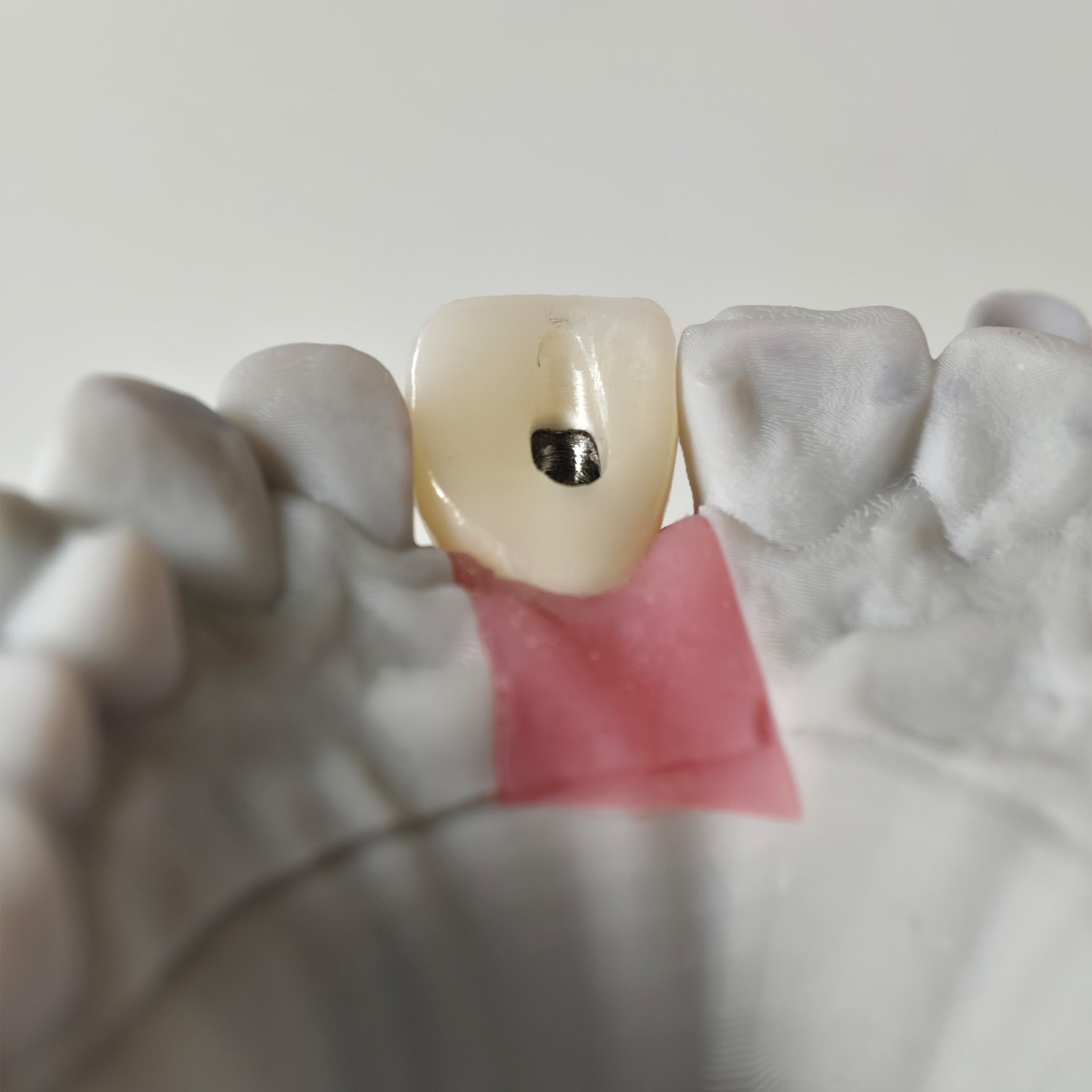Zirconia Crown With Screw Retained