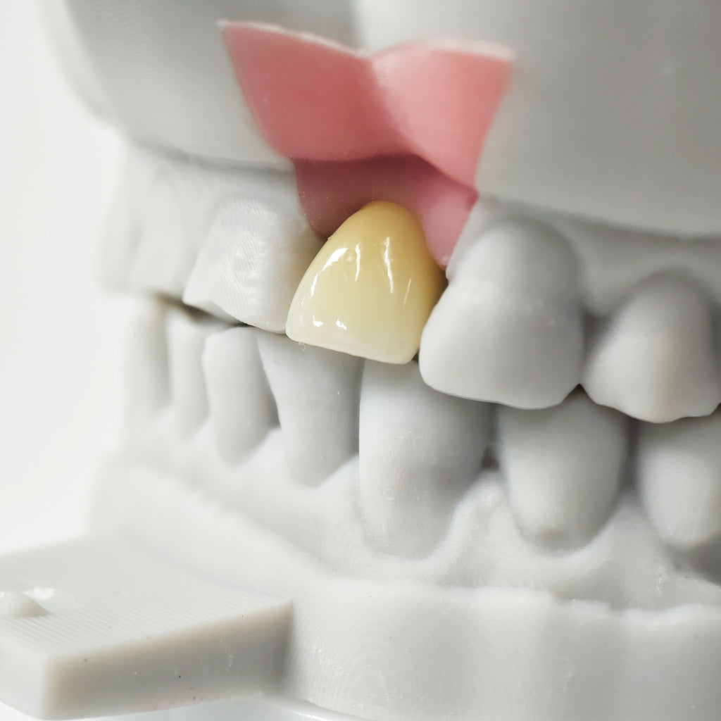 Zirconia Crown With Screw Retained