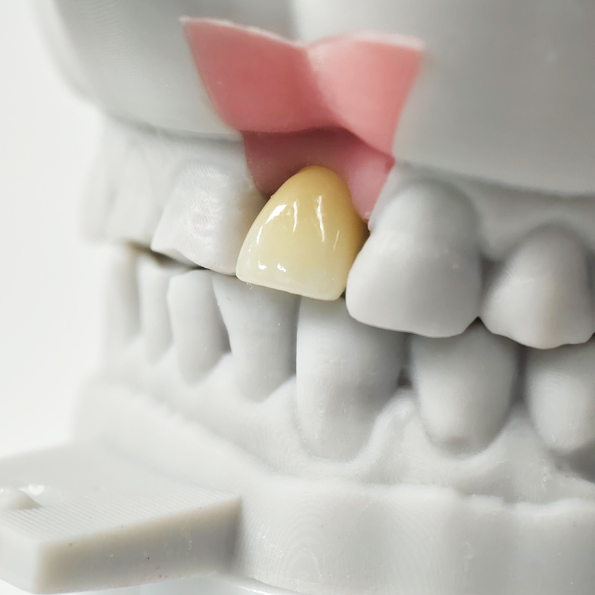 Zirconia Crown With Screw Retained