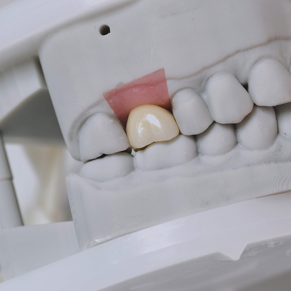 Zirconia Crown With Screw Retained