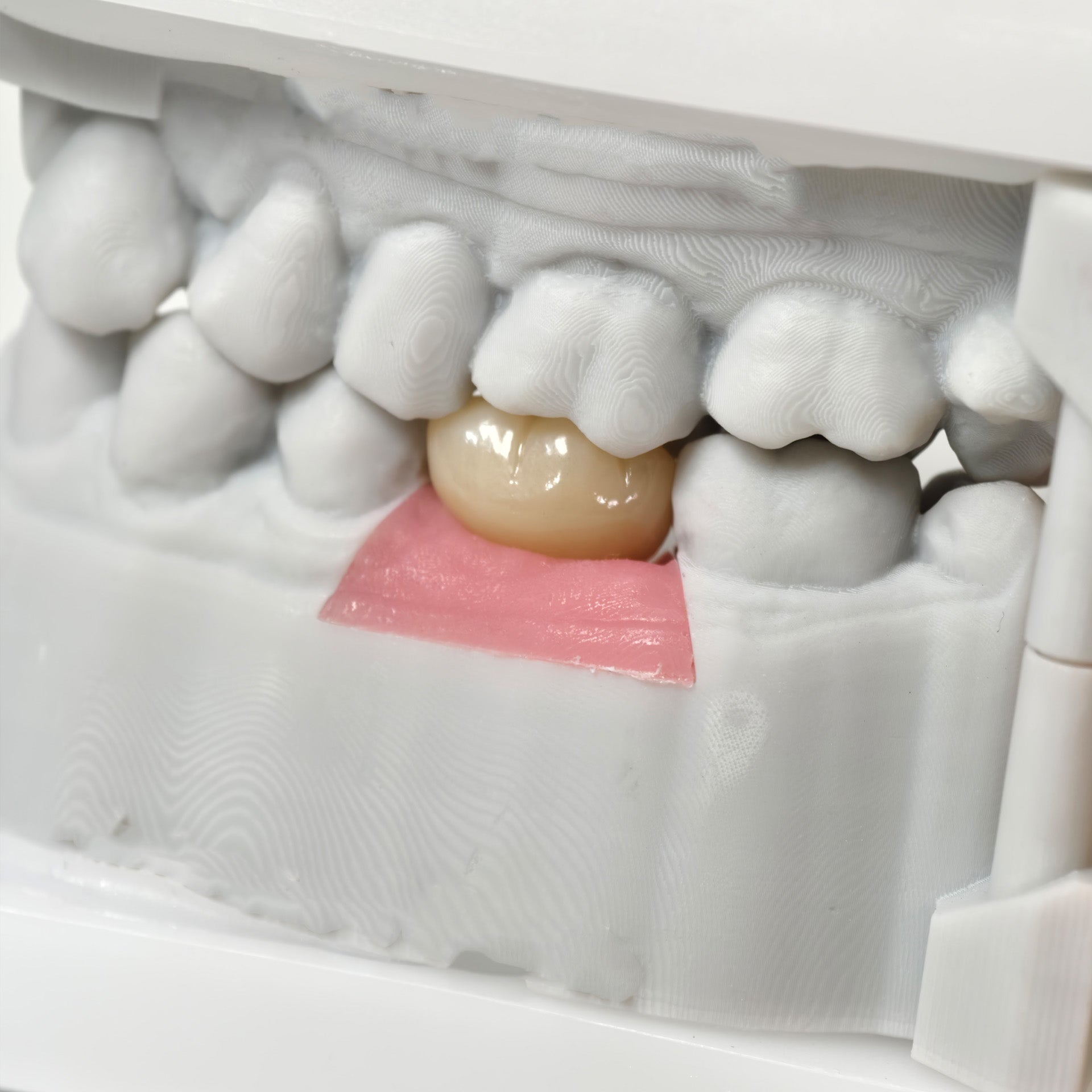 Zirconia Crown With Screw Retained