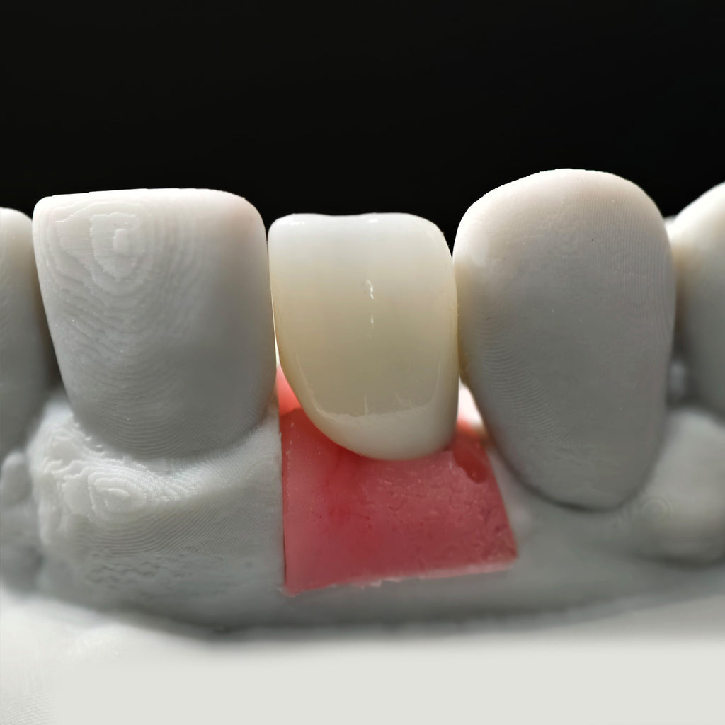Zirconia Crown With Screw Retained
