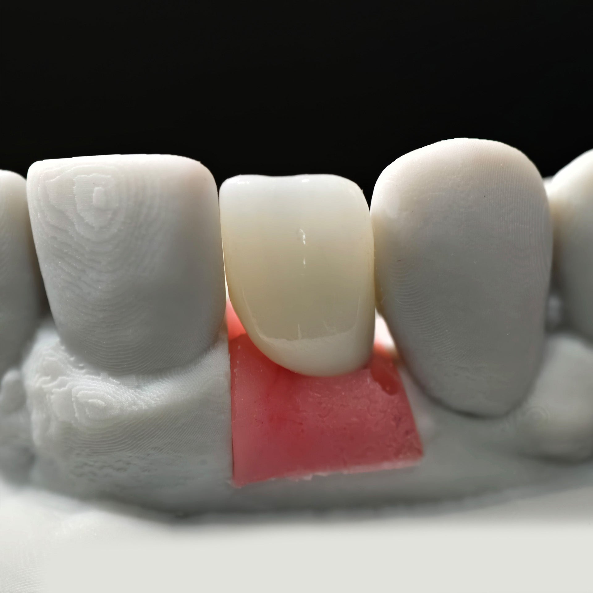 Zirconia Crown With Screw Retained