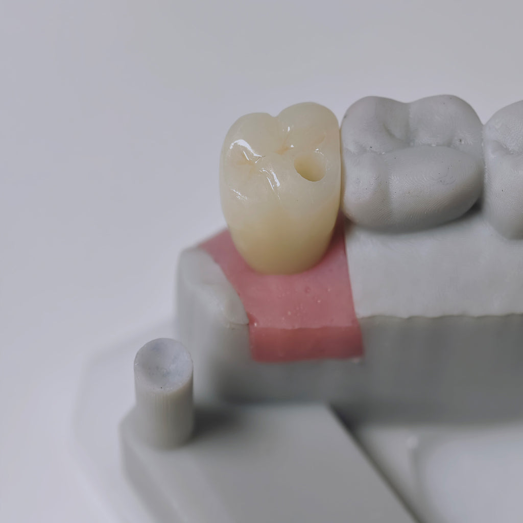 Zirconia Crown With Screw Retained