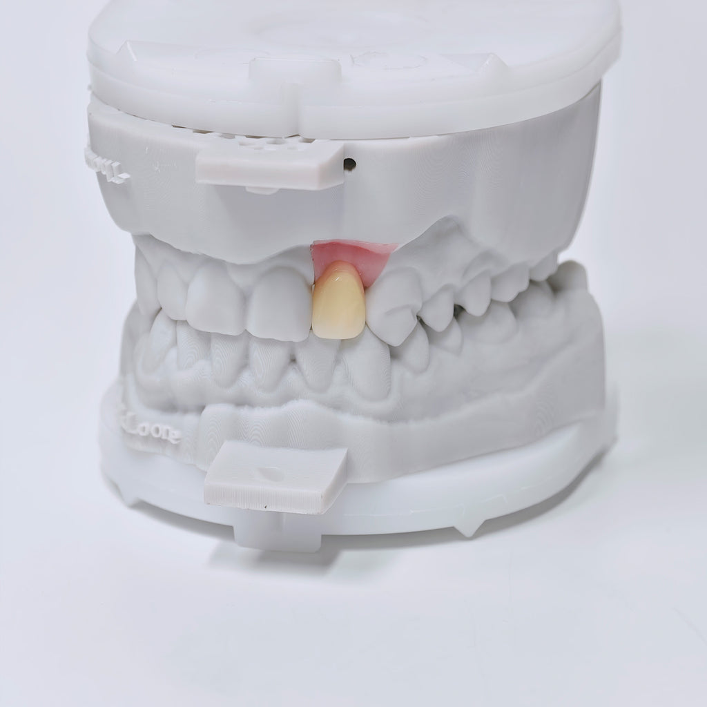 Zirconia Crown With Screw Retained