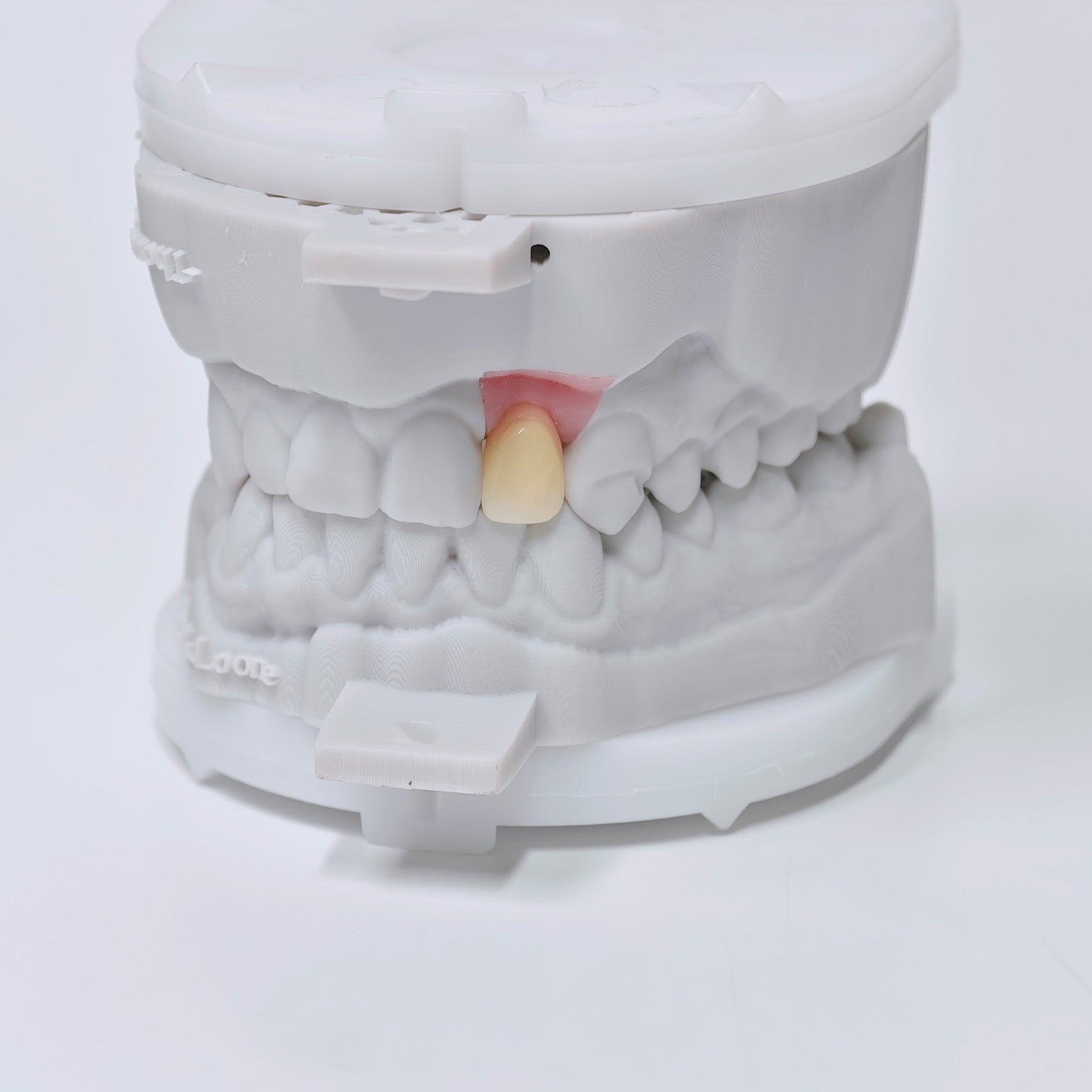 Zirconia Crown With Screw Retained