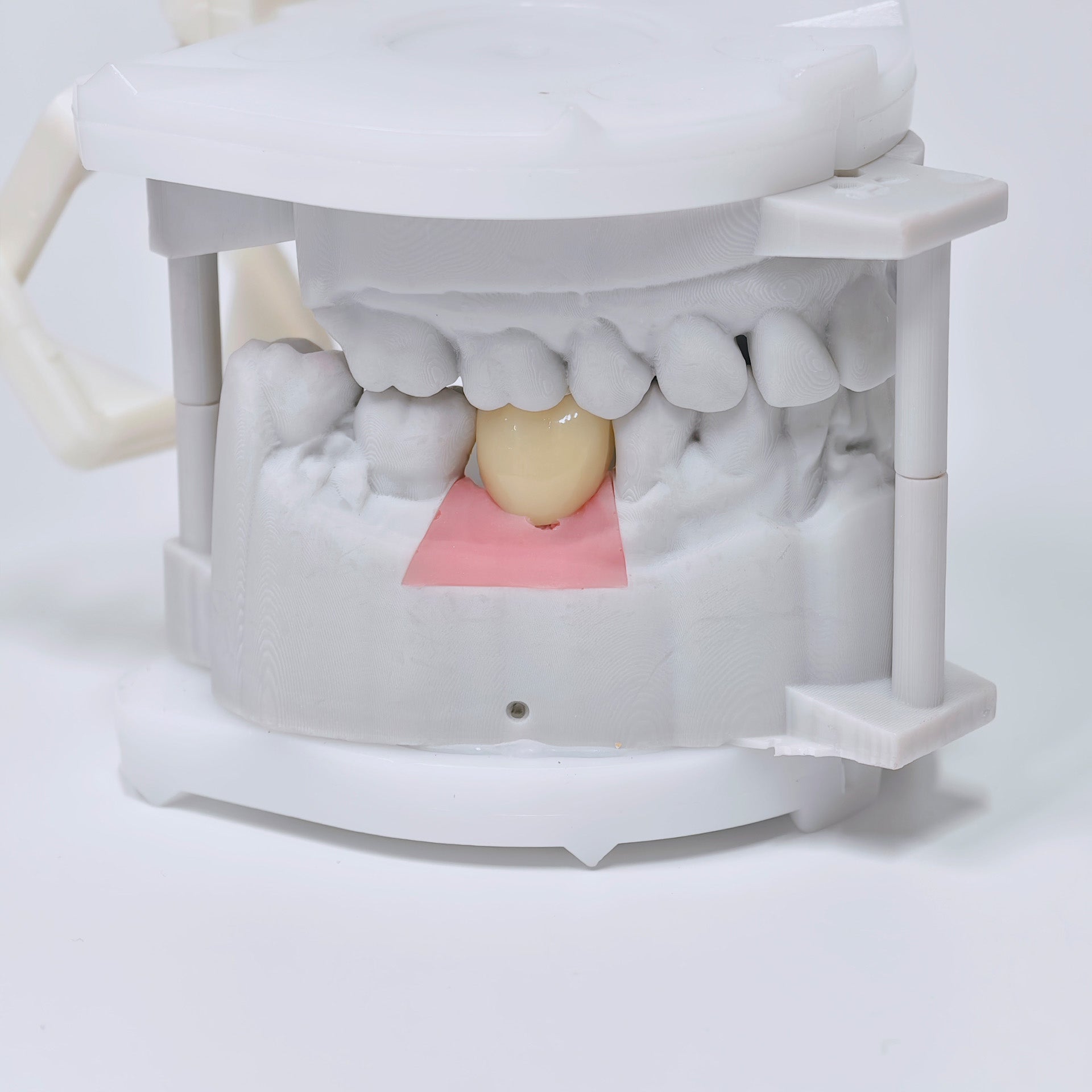 Zirconia Crown With Screw Retained