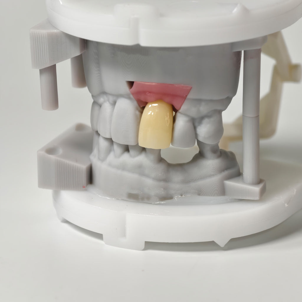 Zirconia Crown With Screw Retained