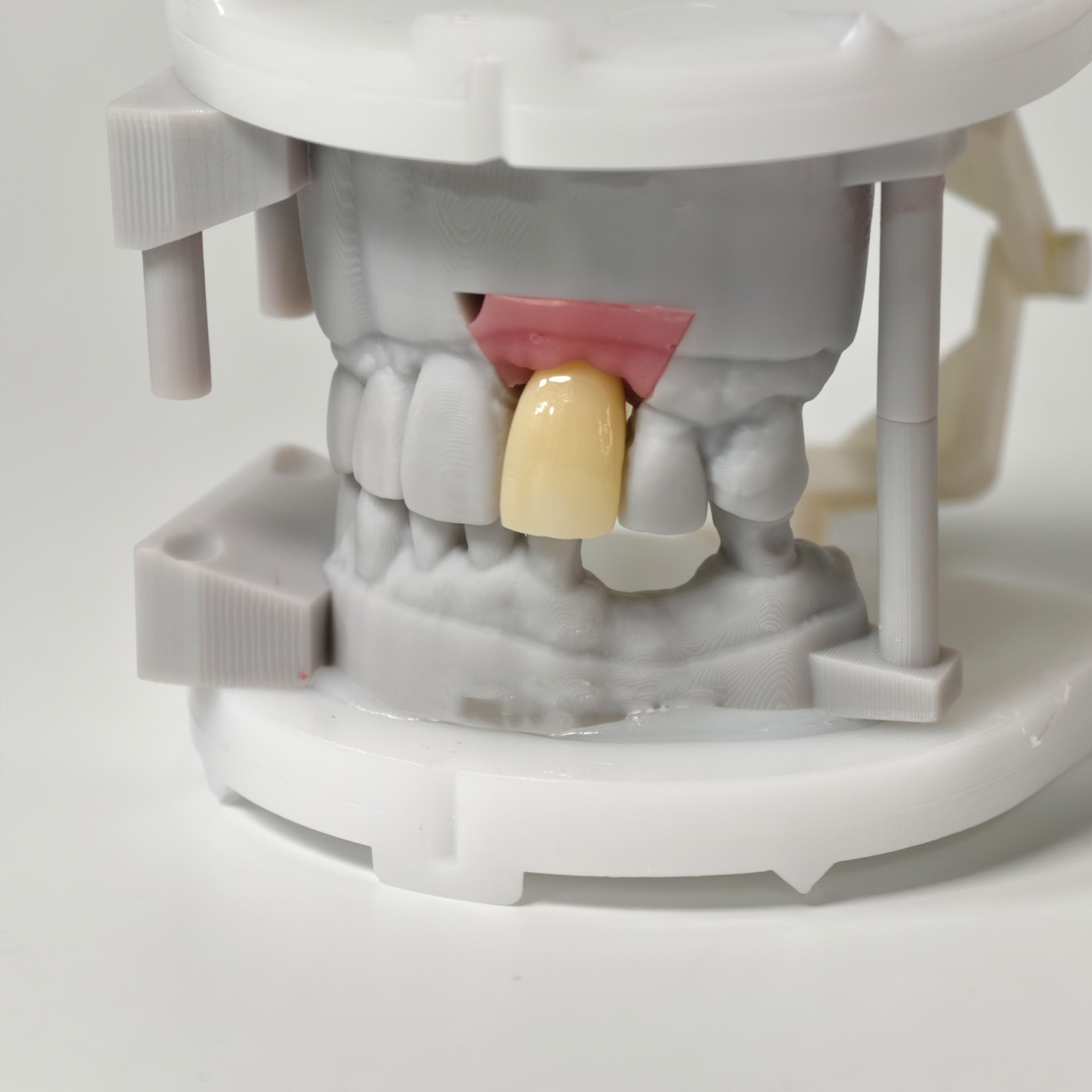Zirconia Crown With Screw Retained