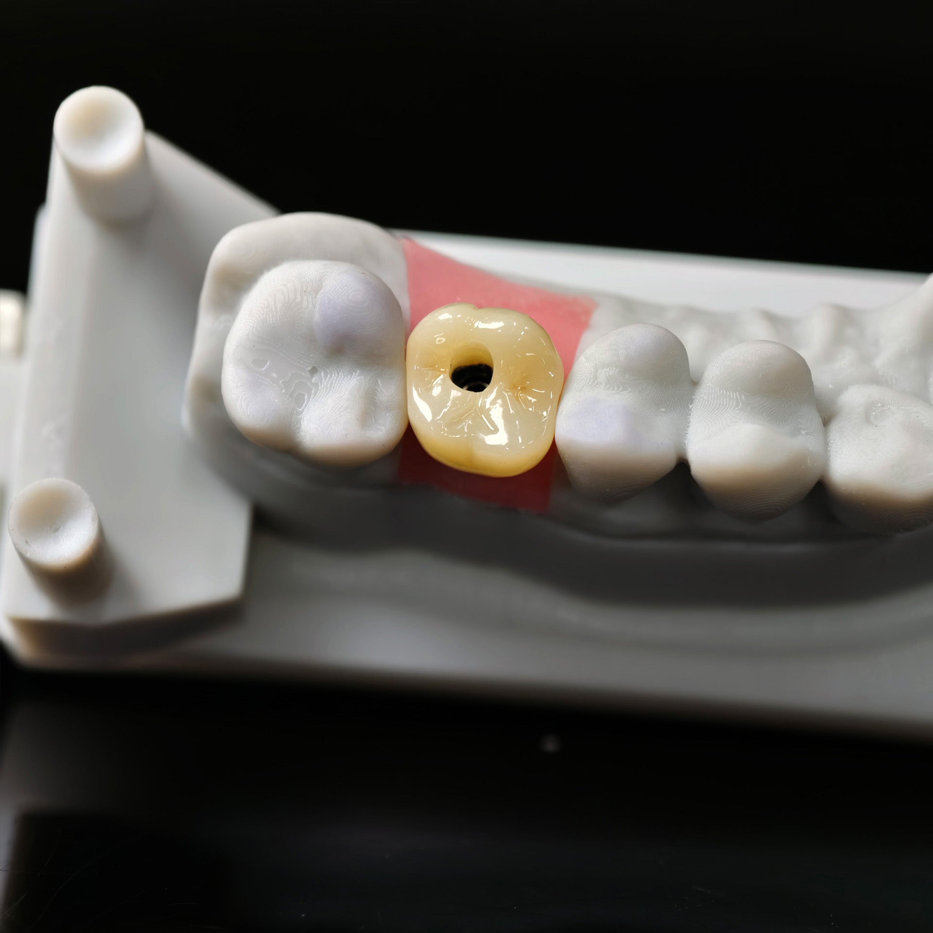 Zirconia Crown With Screw Retained