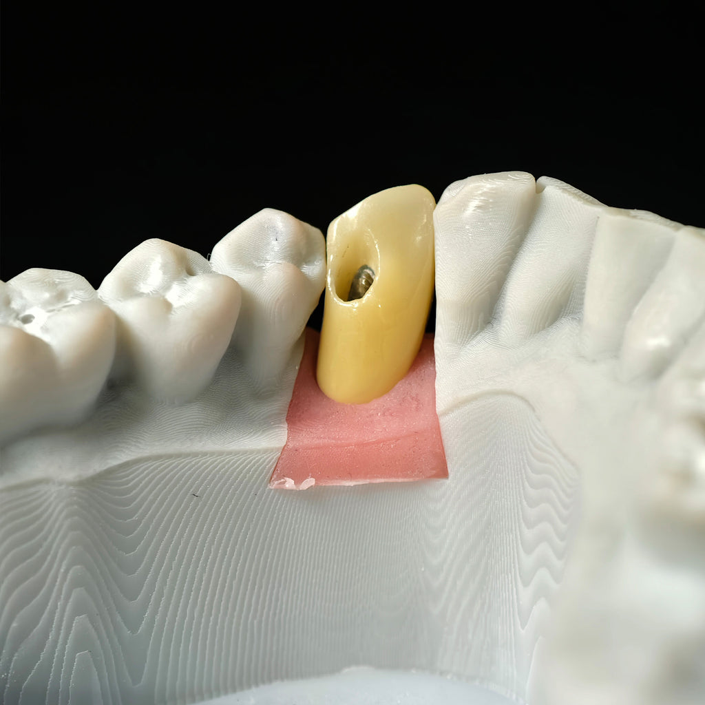 Zirconia Crown With Screw Retained