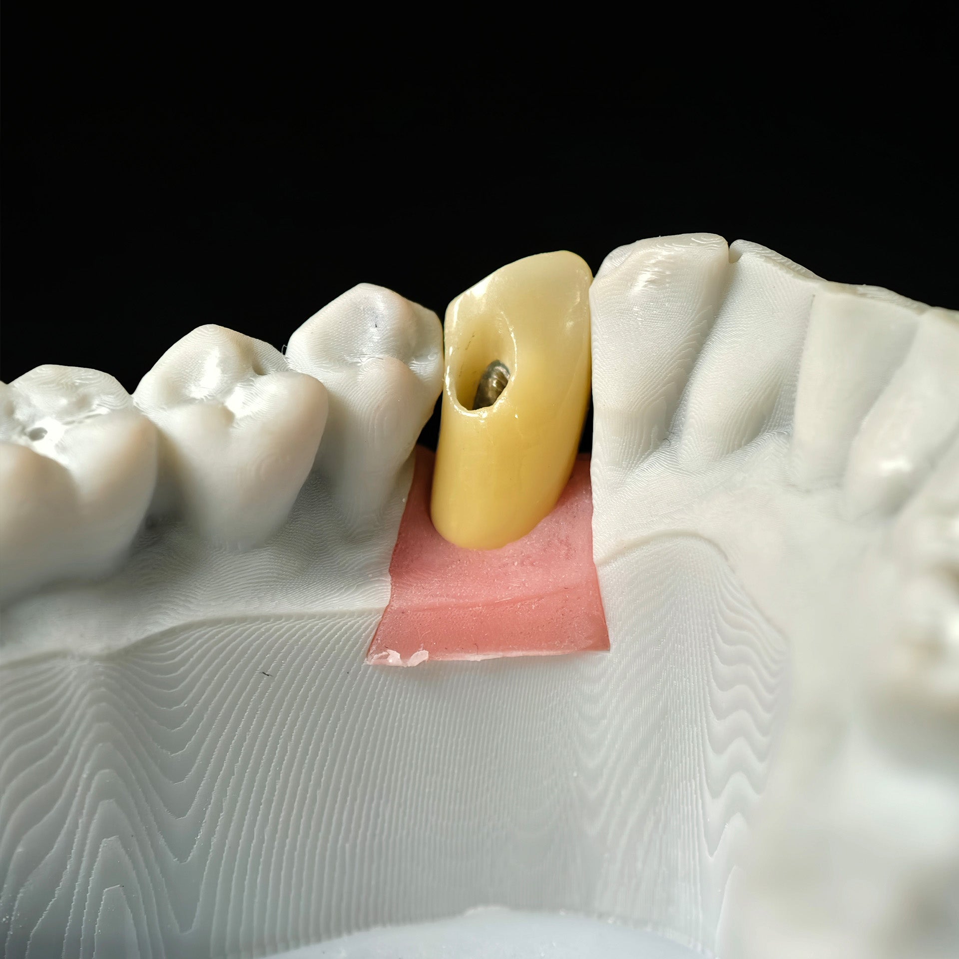 Zirconia Crown With Screw Retained