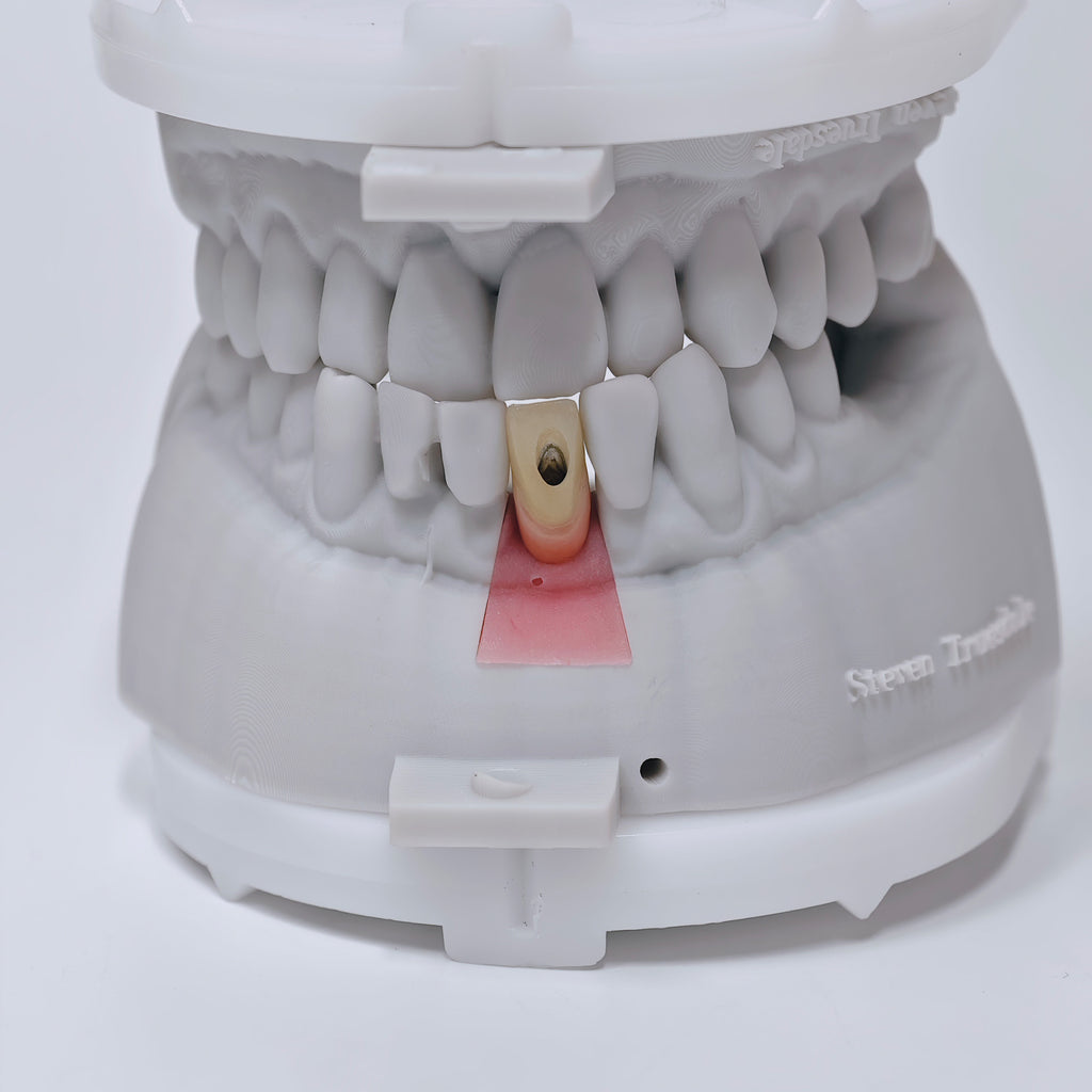 Zirconia Crown With Screw Retained