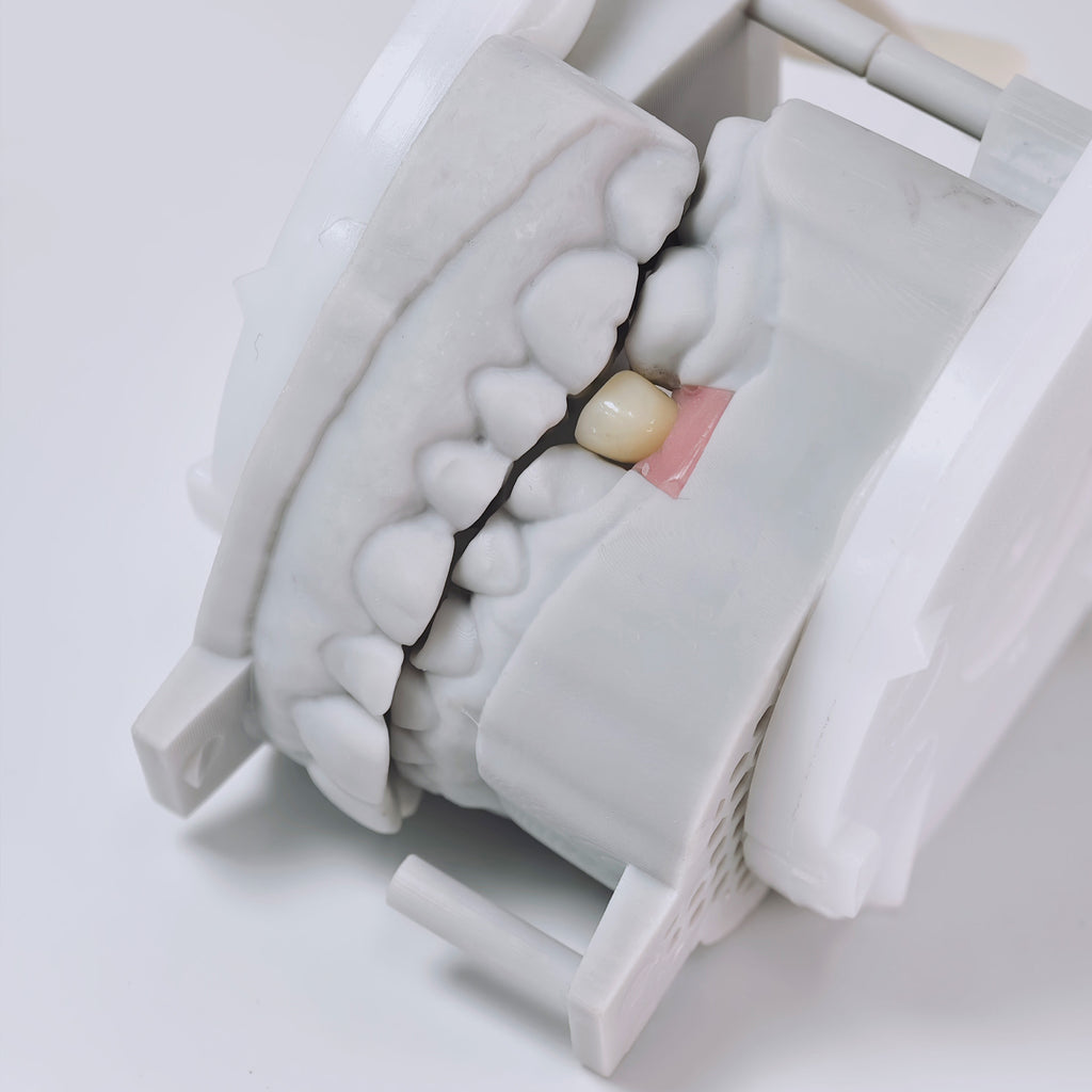 Zirconia Crown With Screw Retained