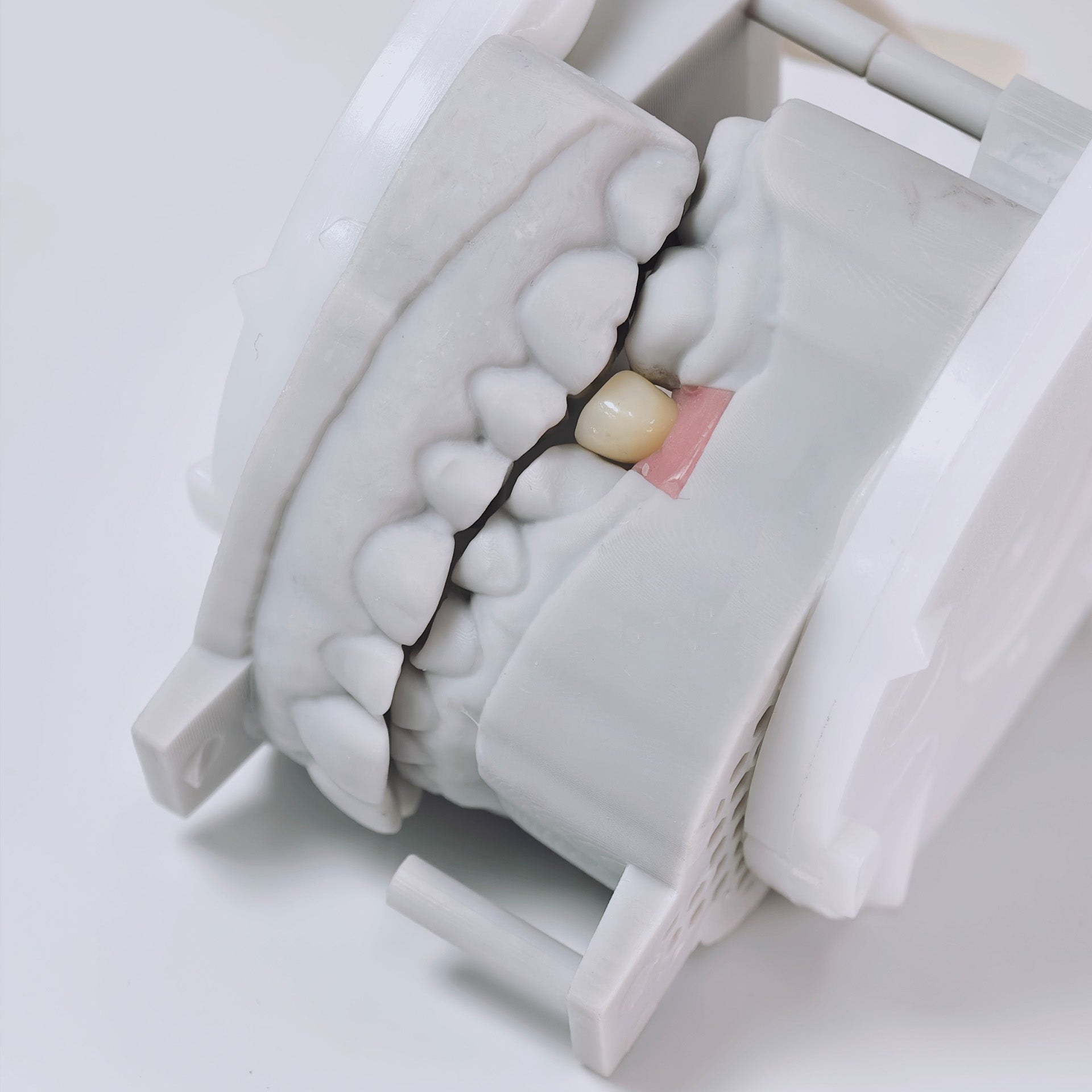 Zirconia Crown With Screw Retained