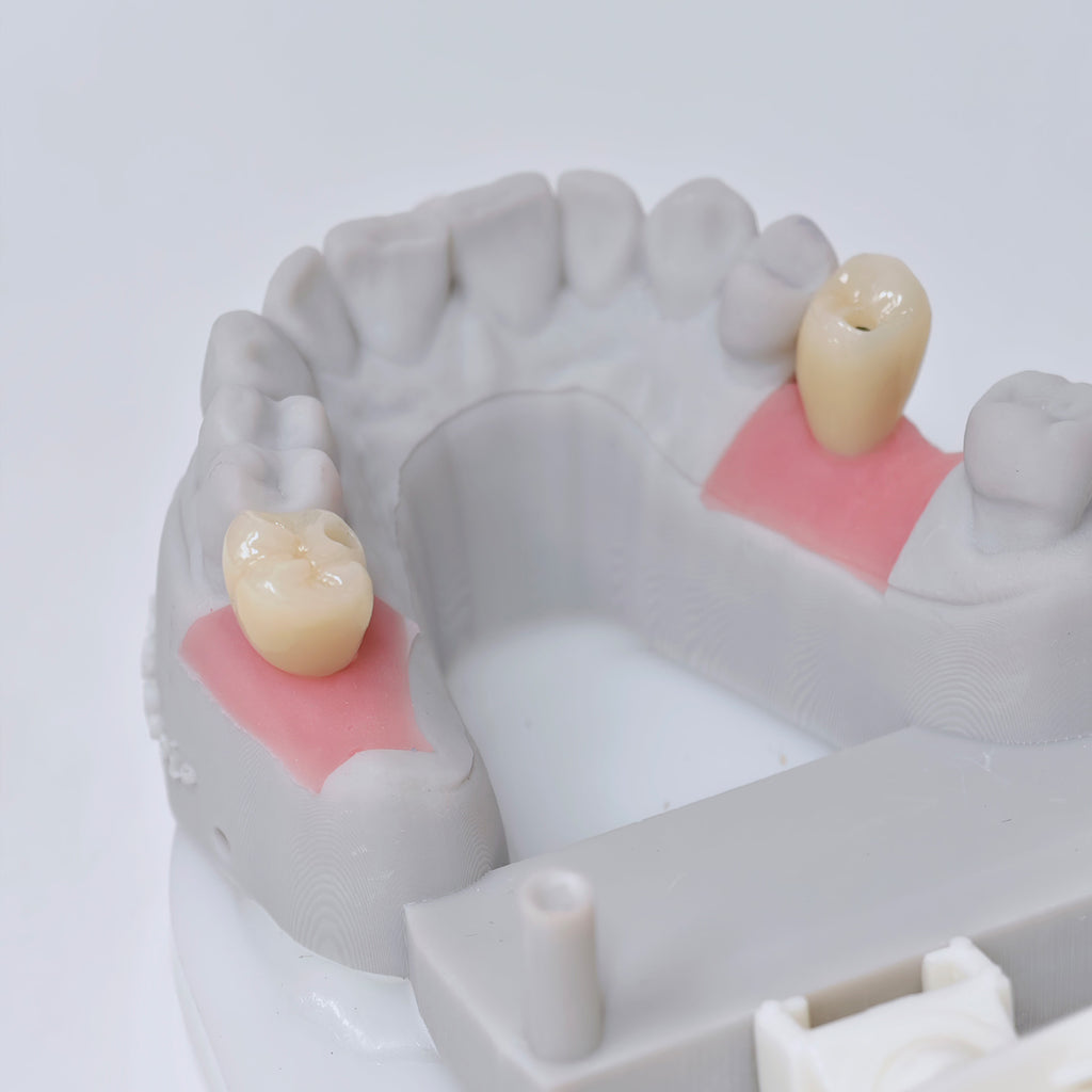 Zirconia Crown With Screw Retained