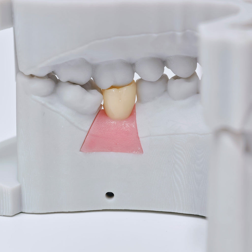 Zirconia Crown With Screw Retained