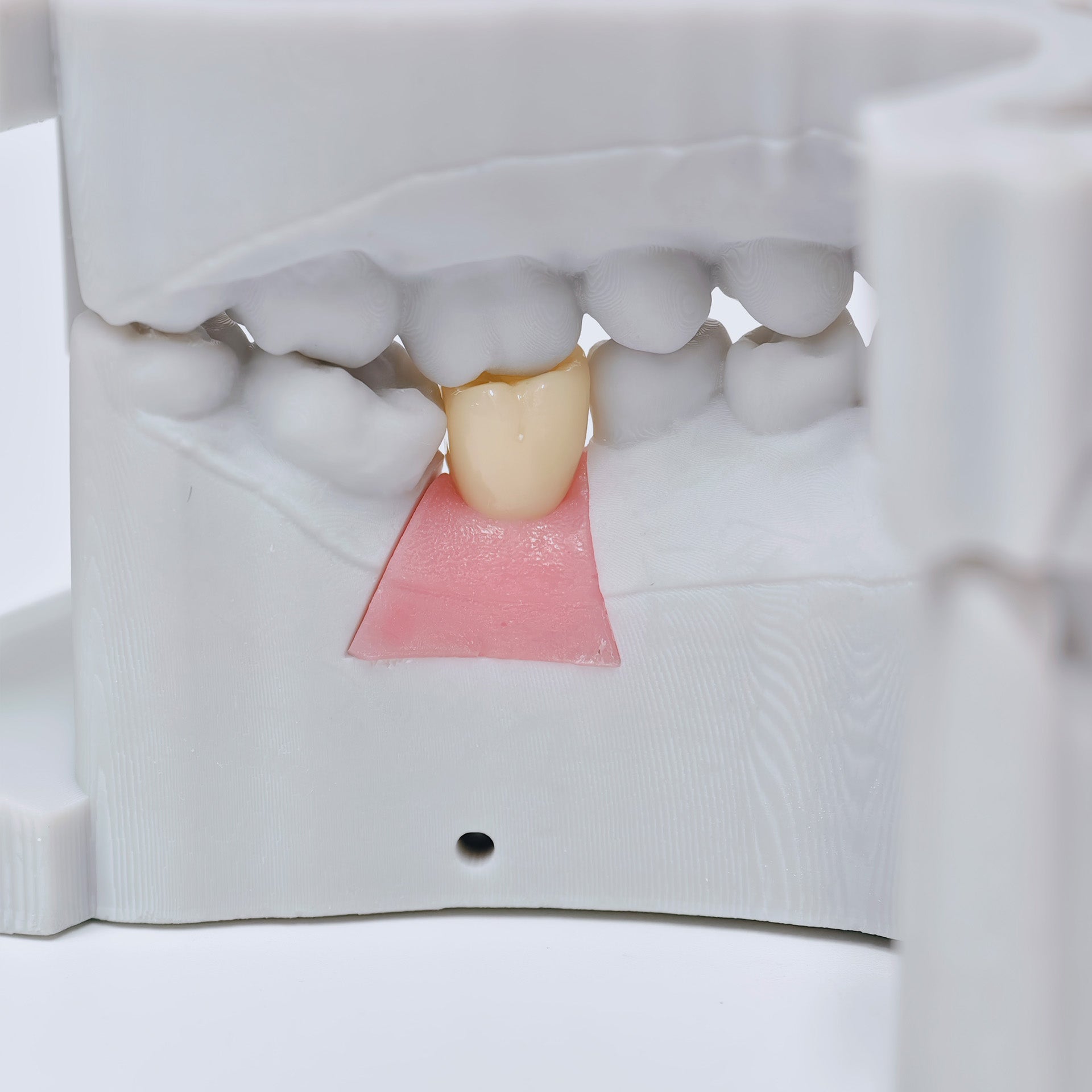 Zirconia Crown With Screw Retained