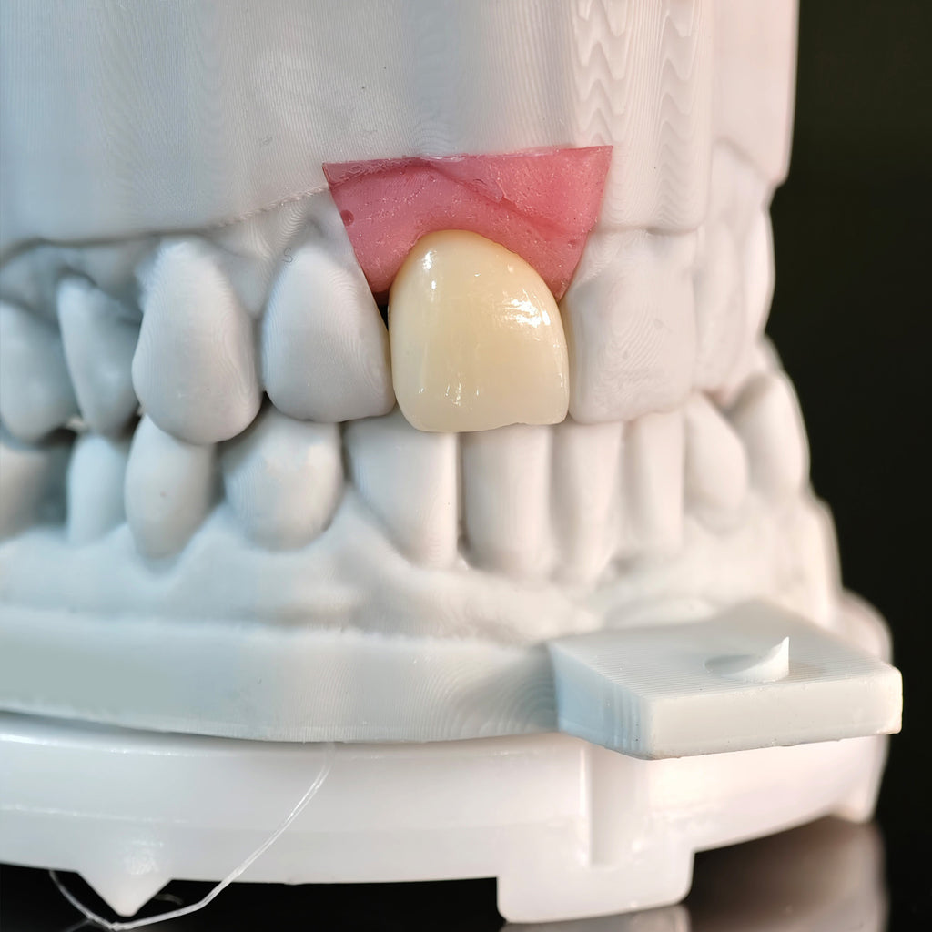 Zirconia Crown With Screw Retained