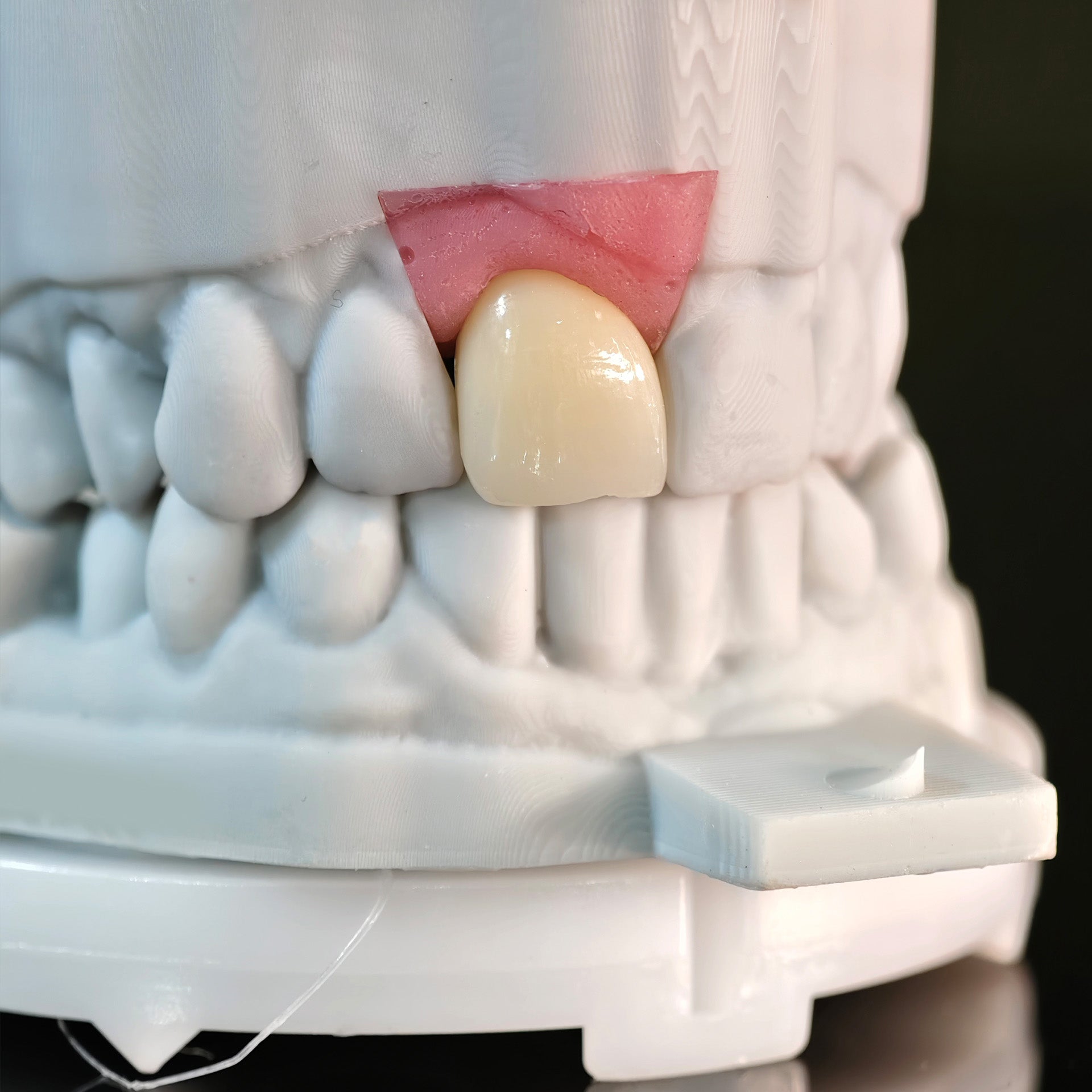 Zirconia Crown With Screw Retained