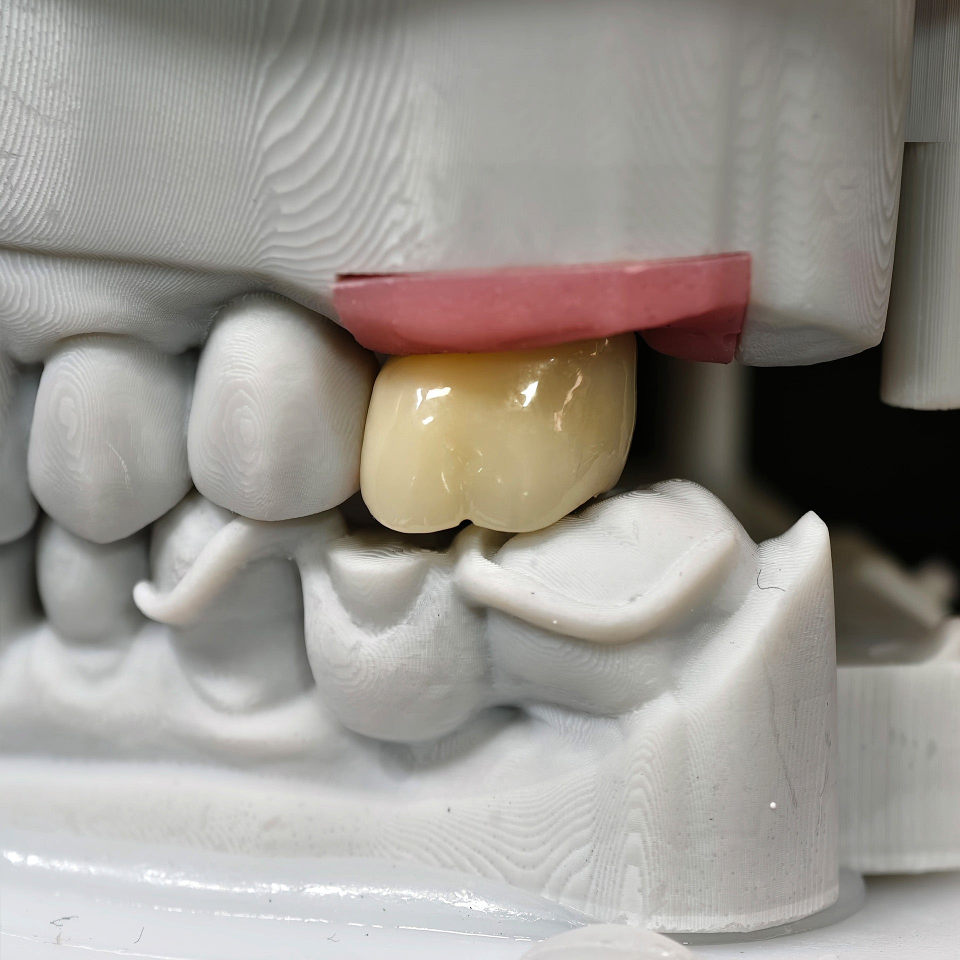 Zirconia Crown With Screw Retained