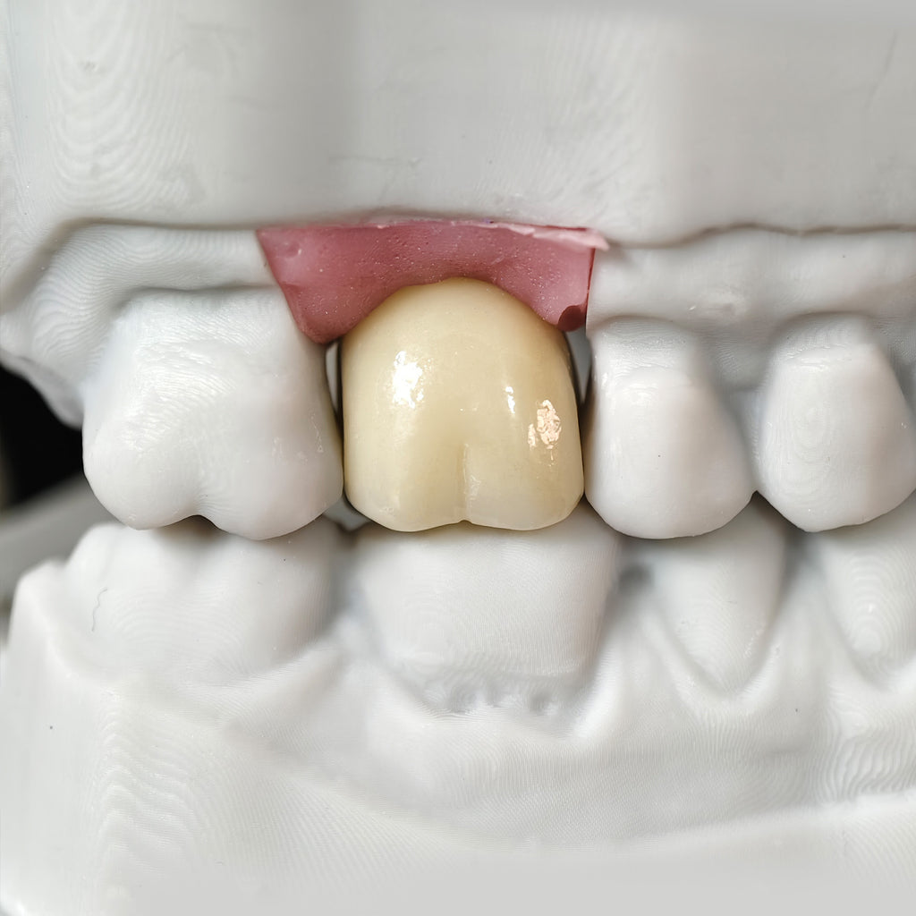 Zirconia Crown With Screw Retained