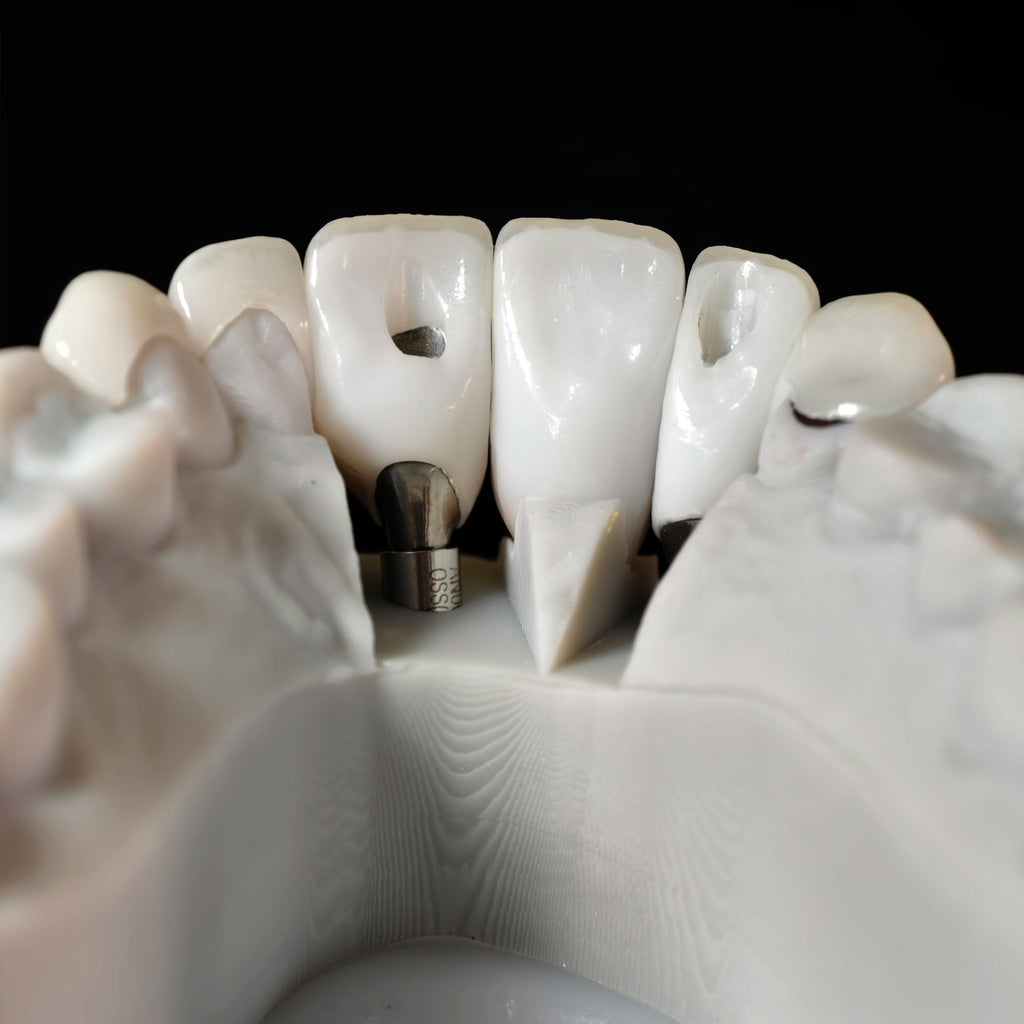 Zirconia Crown With Screw Retained And Cement Retained And Ceramic Veneers