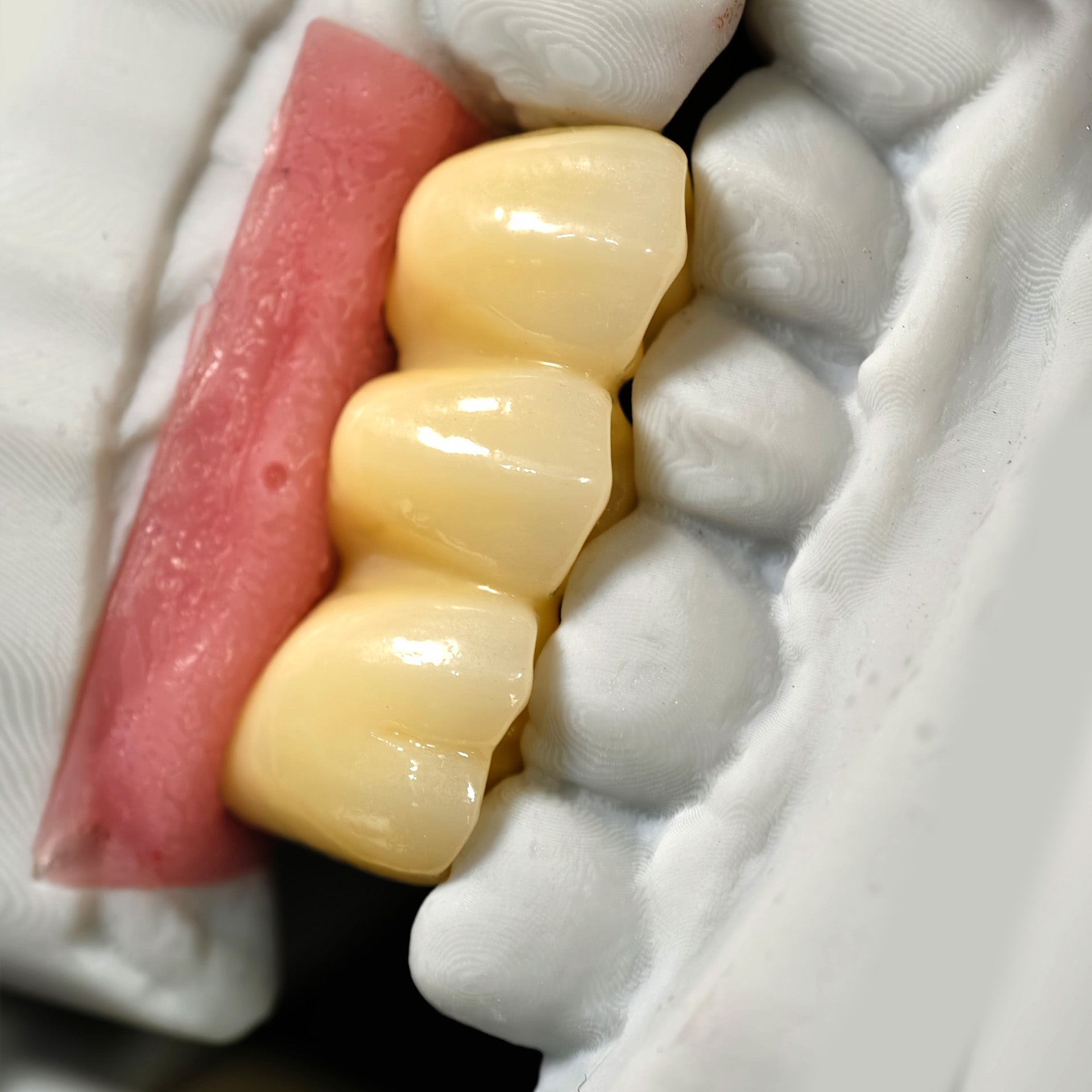 Zirconia Implant Bridge Screwmentable Dental Crown