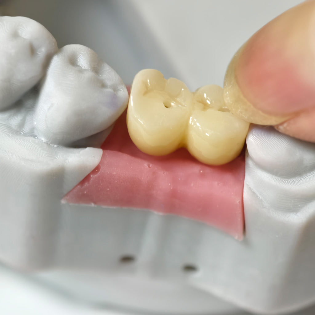 Zirconia Implant Bridge Screwmentable Dental Crown