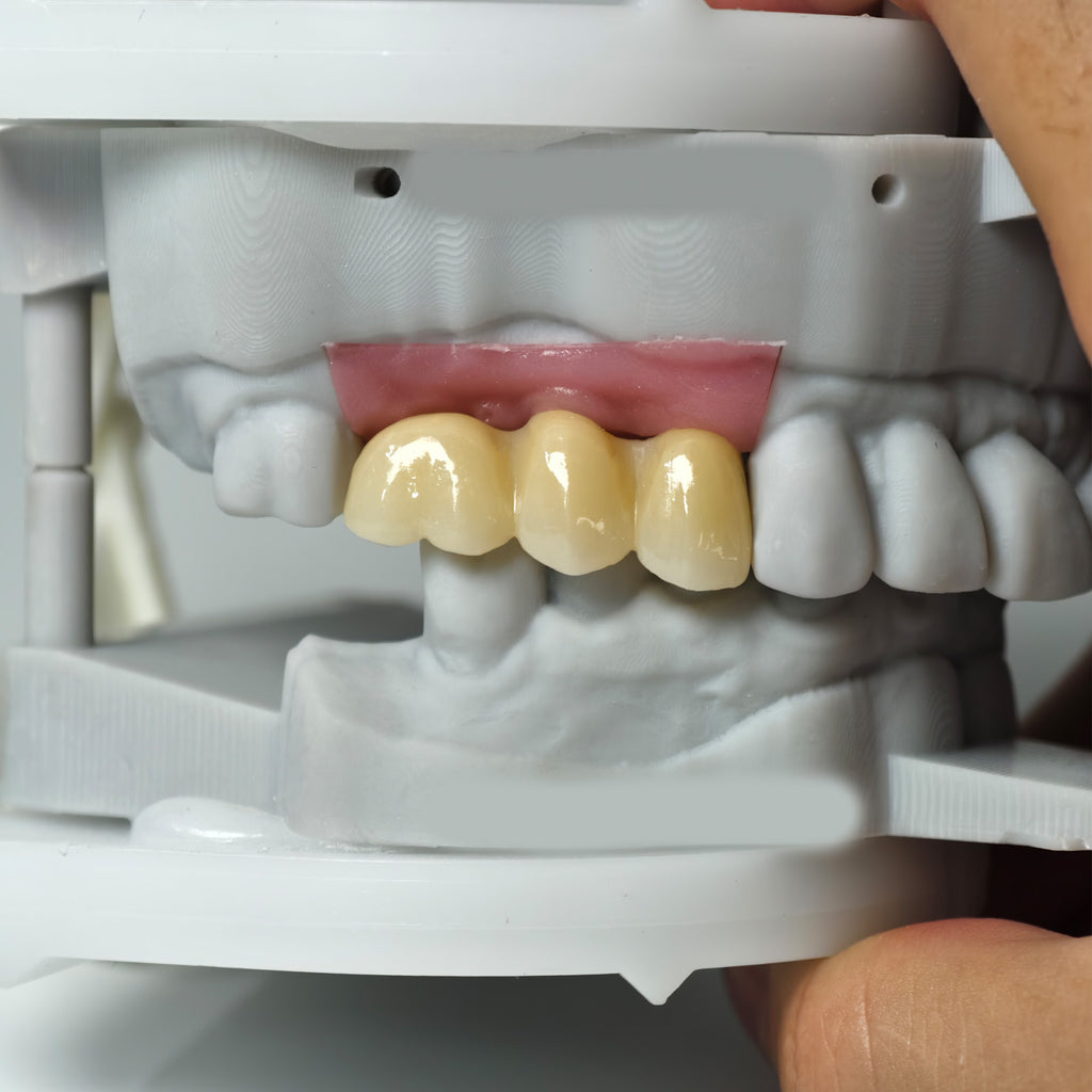 Zirconia Implant Bridge Screwmentable Dental Crown