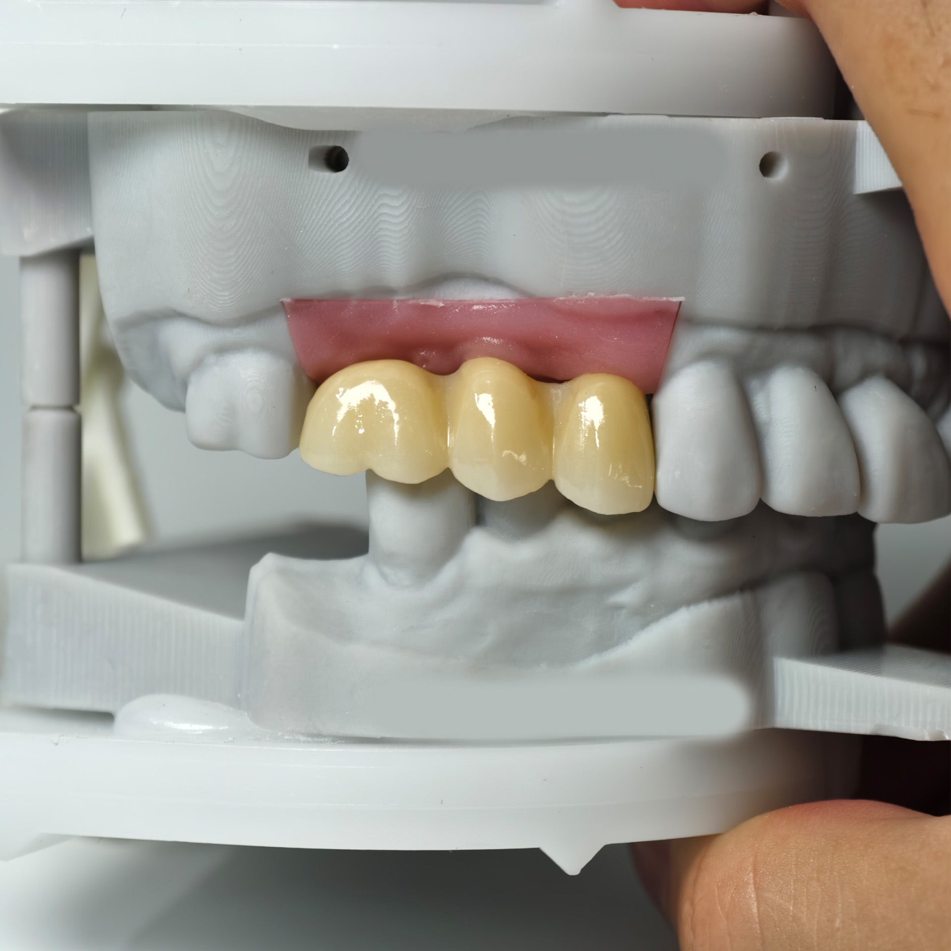 Zirconia Implant Bridge Screwmentable Dental Crown