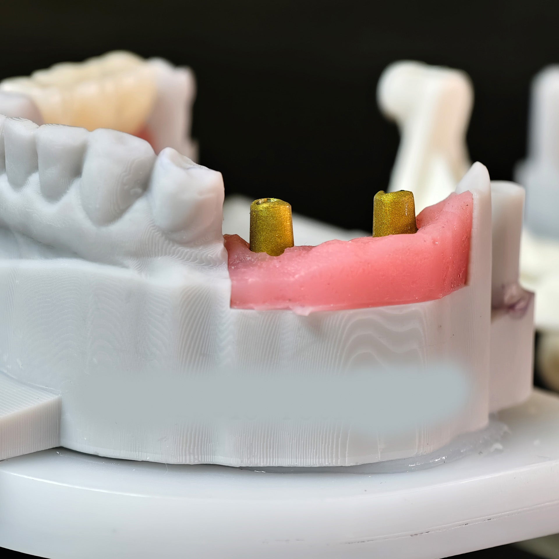 Zirconia Implant Bridge Screwmentable Dental Crown