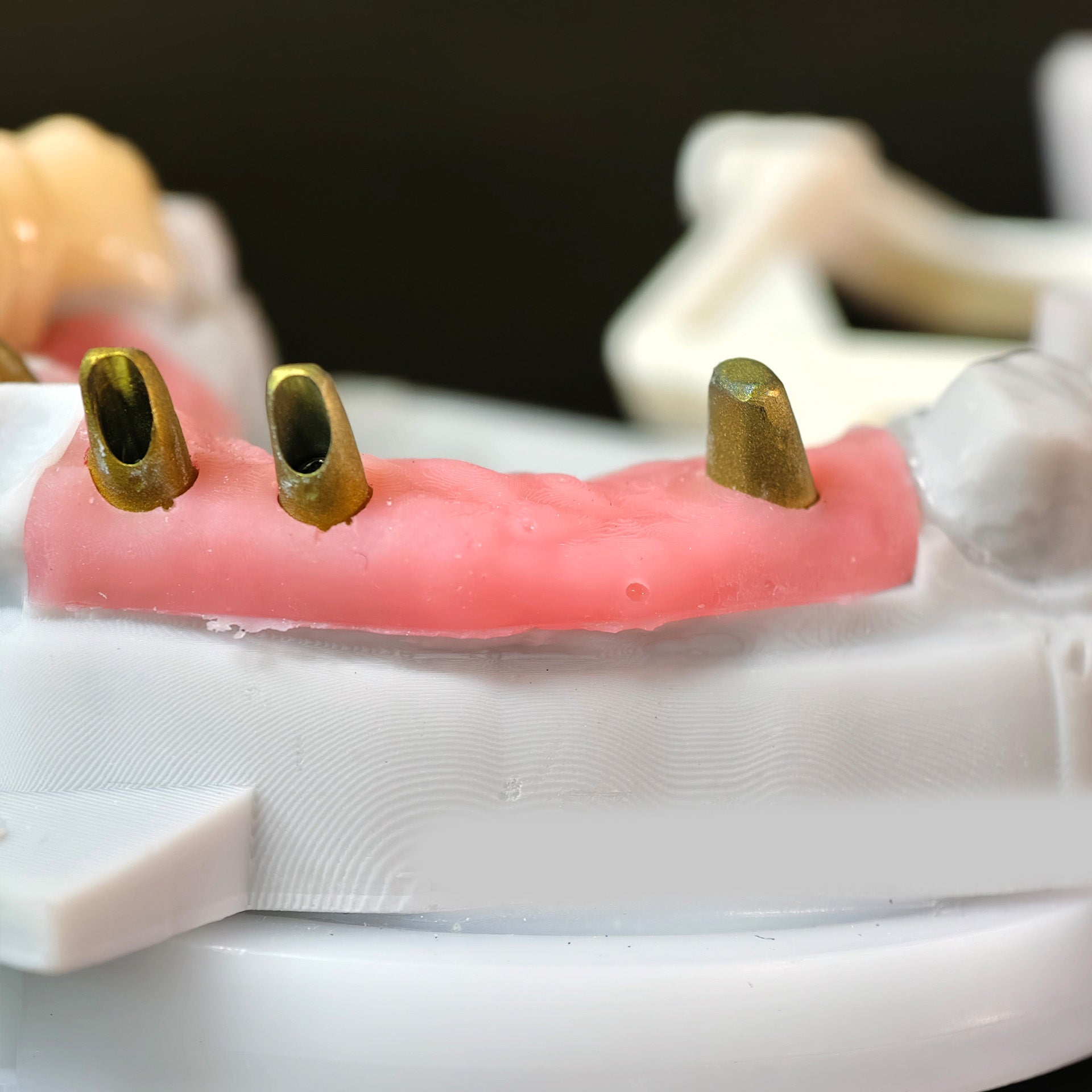 Zirconia Implant Bridge Screwmentable Dental Crown