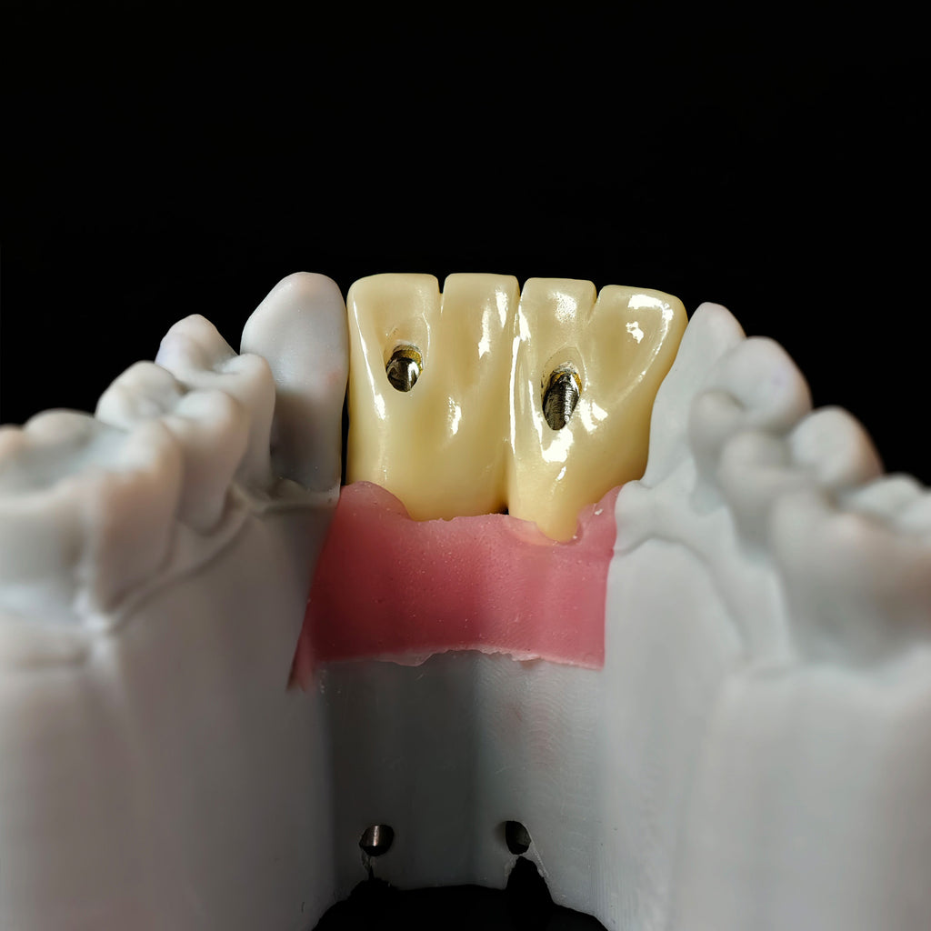 Zirconia Implant Bridge With Gold Plating