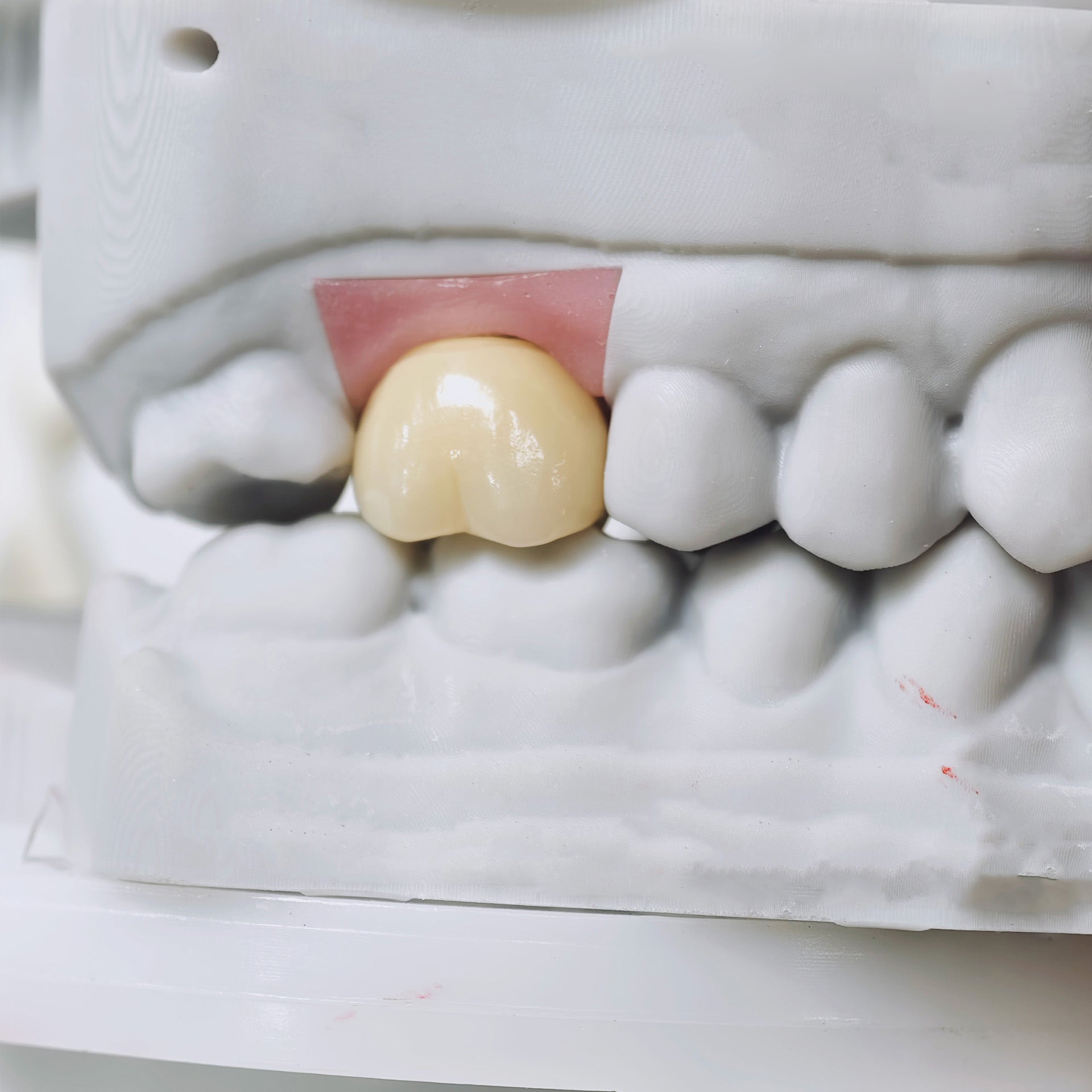 Zirconia Implant Crown Screwmentable Dental Crown