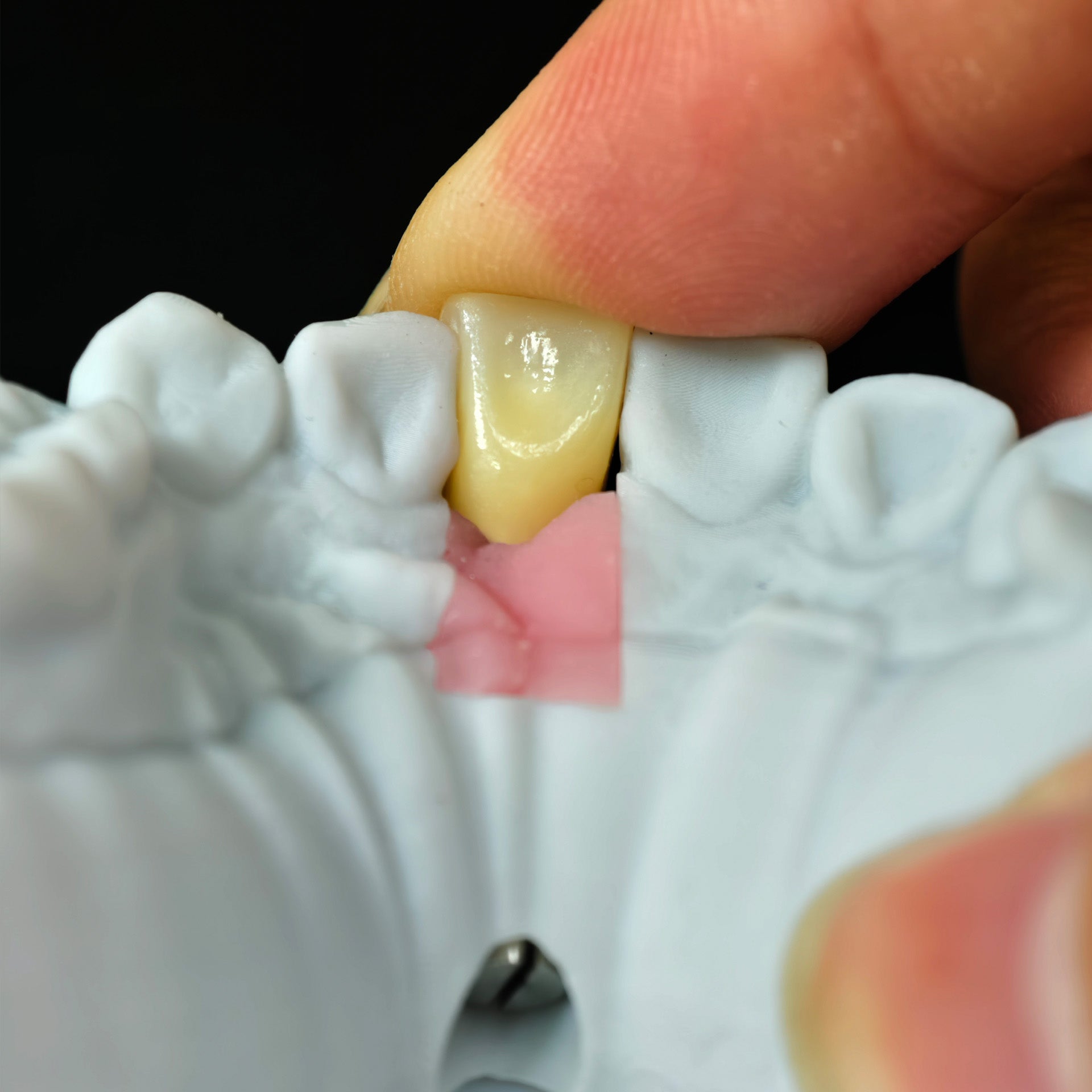 Zirconia Implant Crown Screwmentable Dental Crown