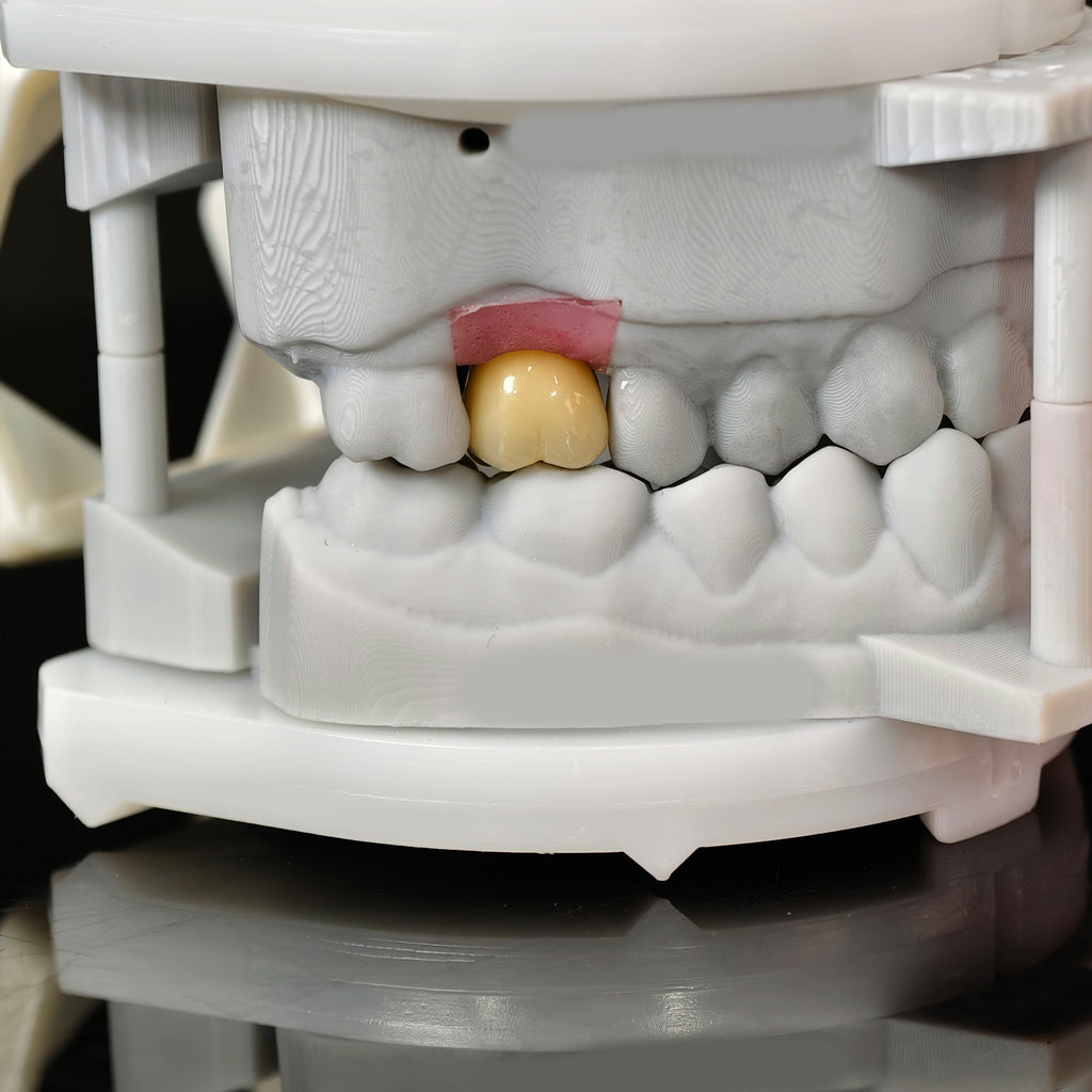 Zirconia Implant Crown With Gold Plating