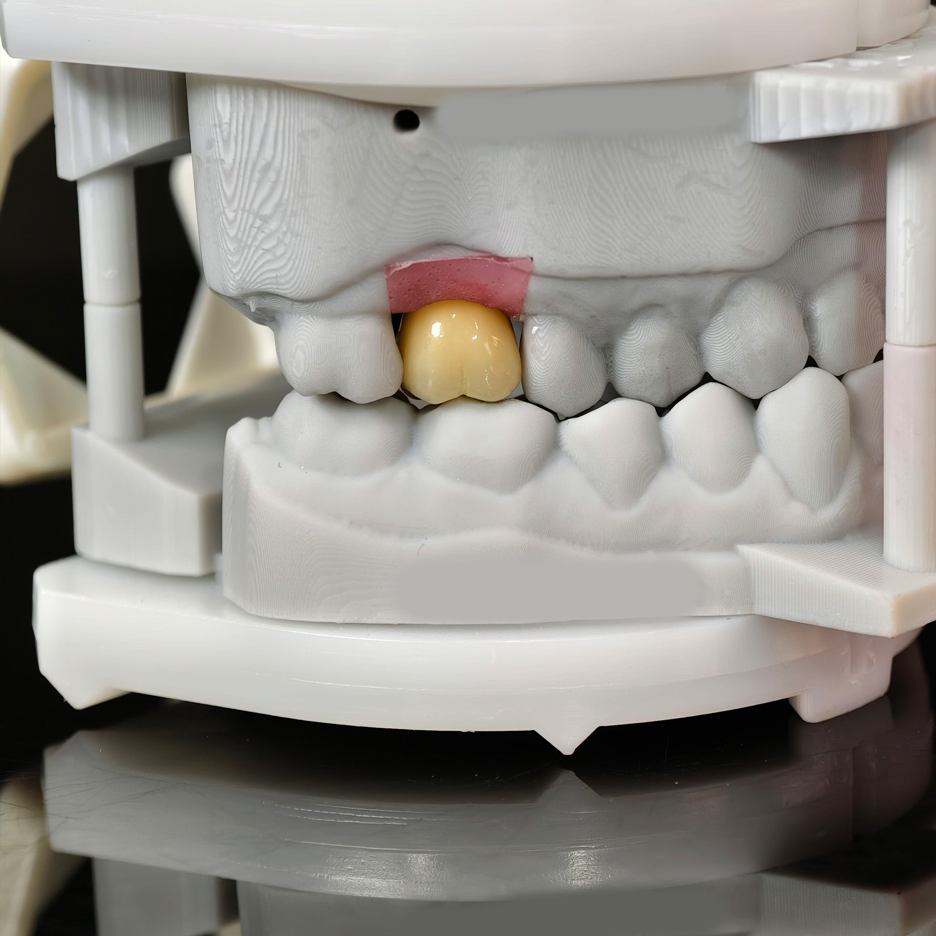 Zirconia Implant Crown With Gold Plating