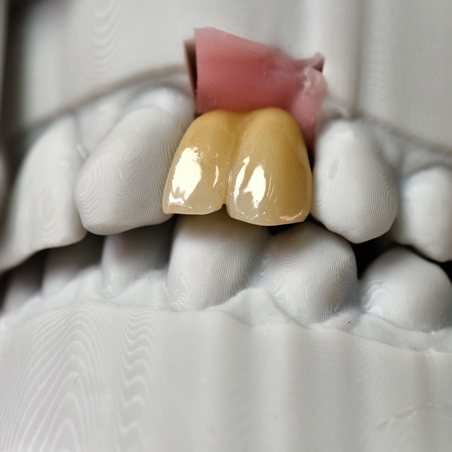Zirconia Implant Crown With Gold Plating