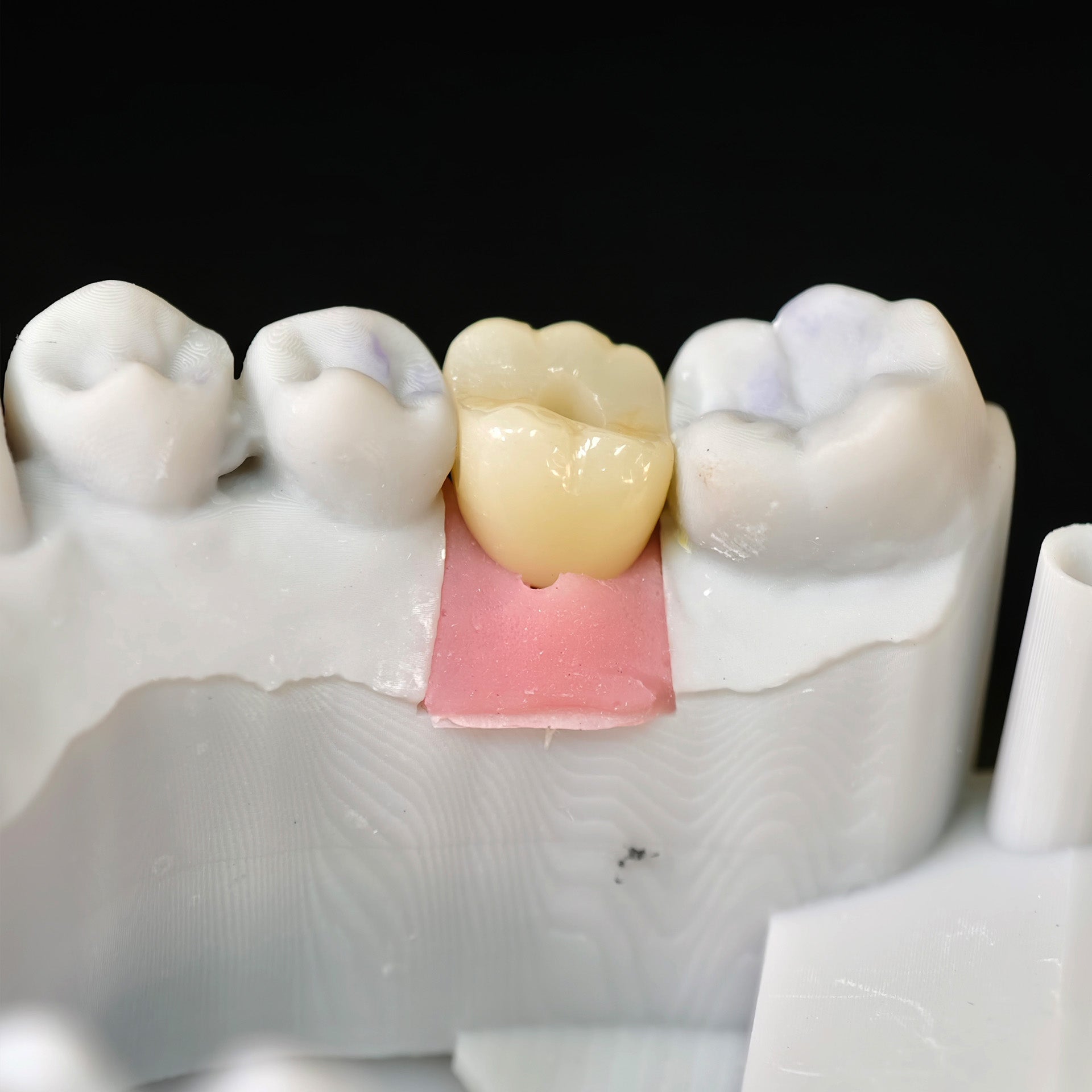 Zirconia Implant Crown With Gold Plating