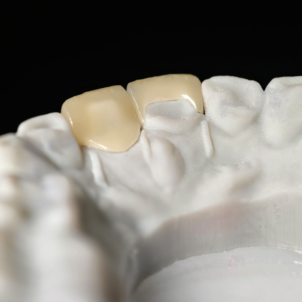 Zirconia Veneer. High Transparency/Translucent, Natural Shade